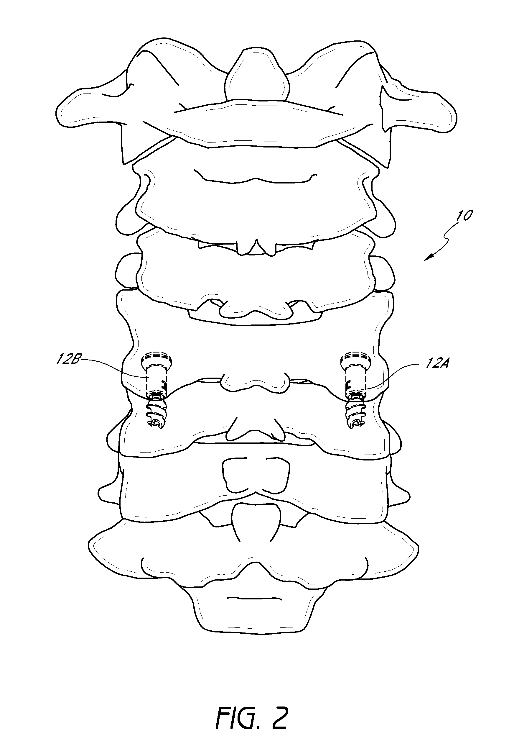 Method and apparatus for spinal fixation