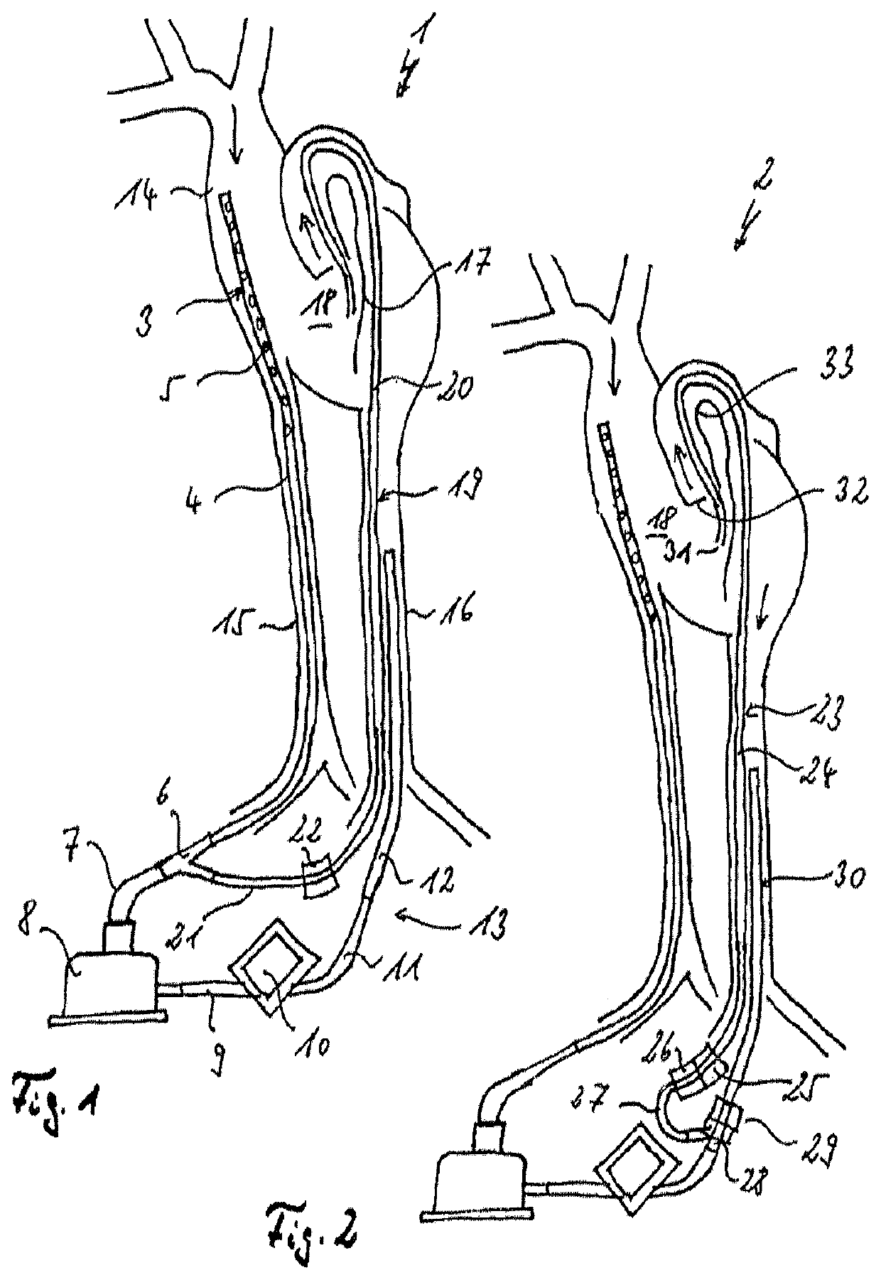 Assembly comprising a suction line, a pressure line and a pump