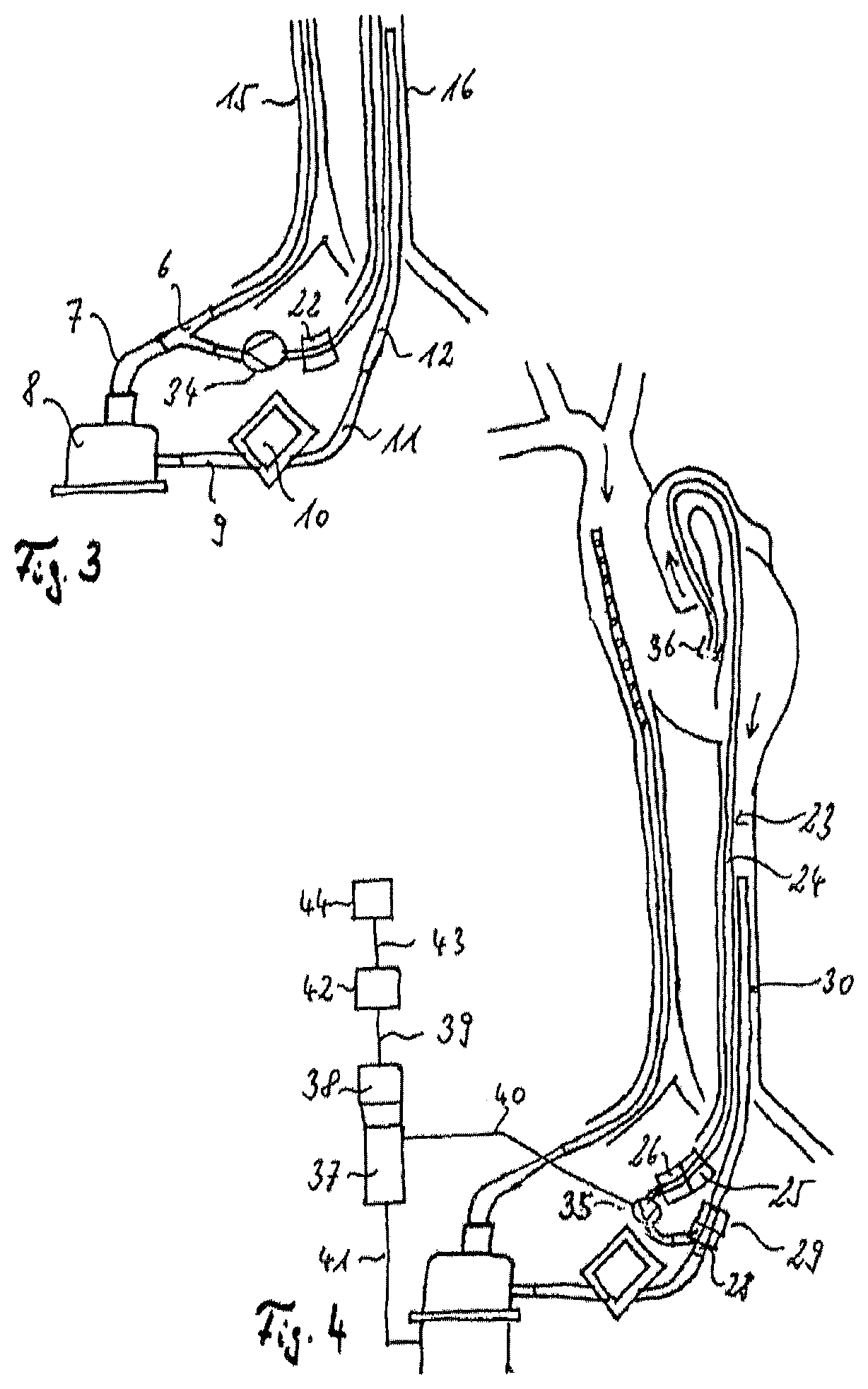 Assembly comprising a suction line, a pressure line and a pump