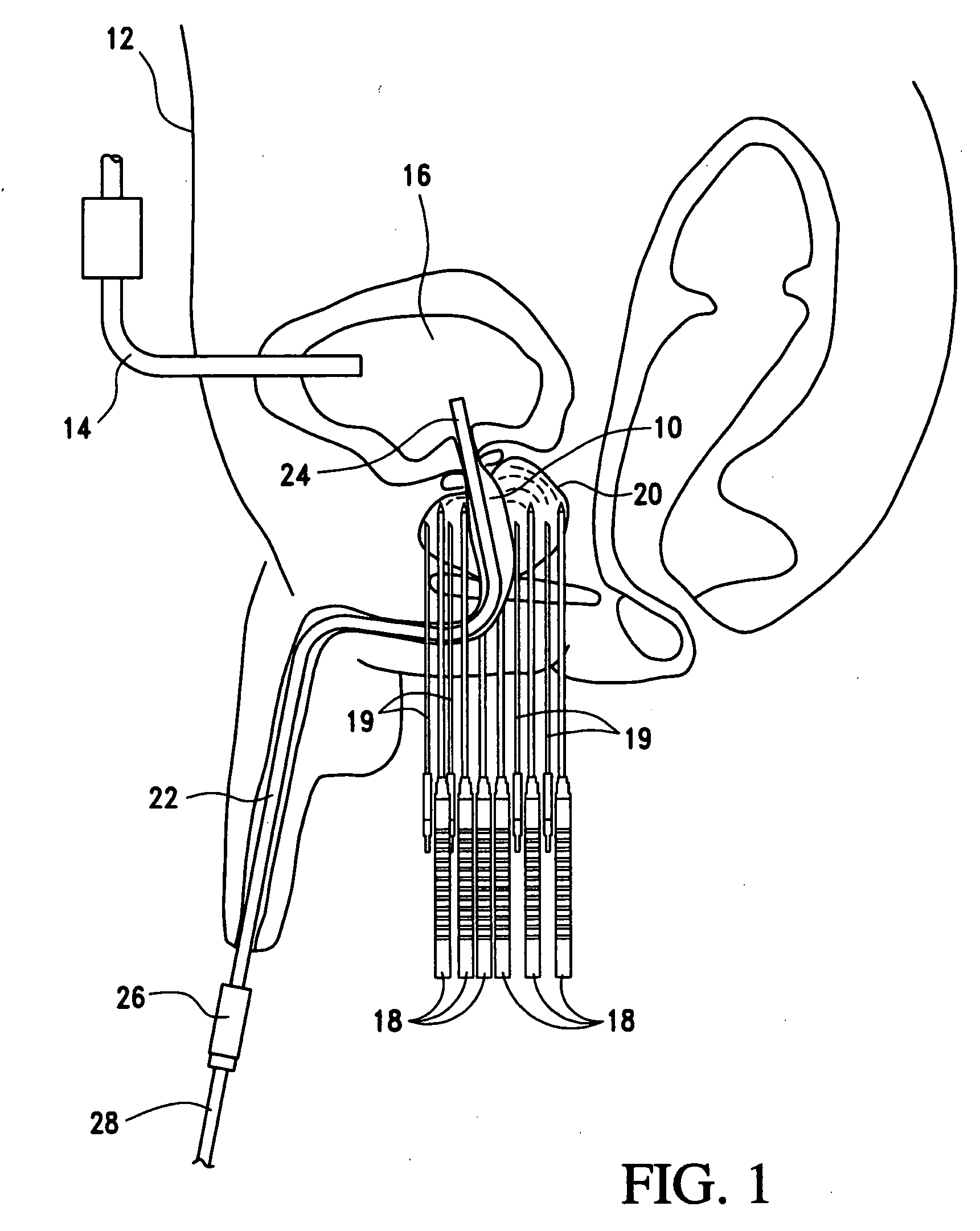 Open system heat exchange catheters and methods of use