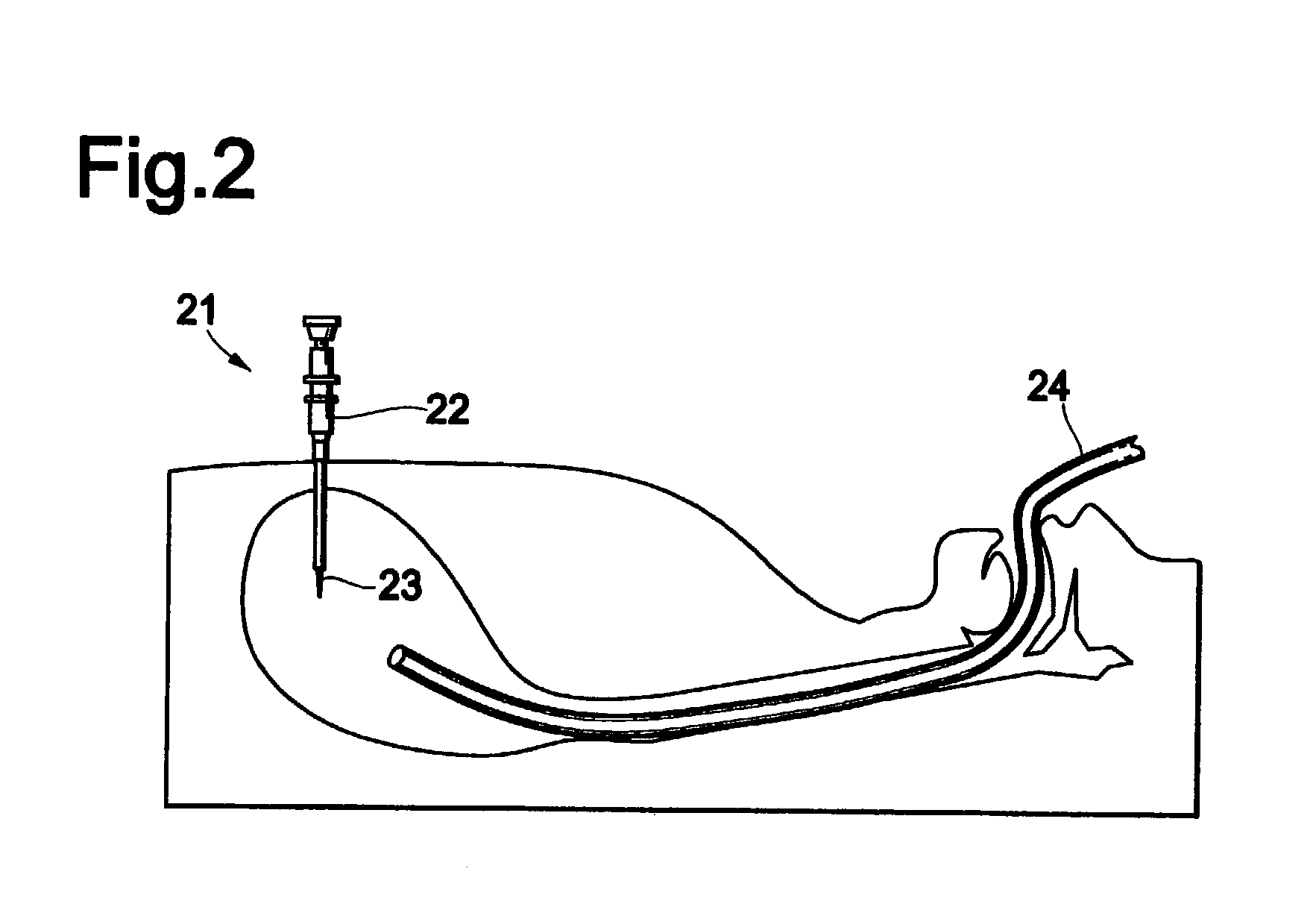 Method of gastrostomy, and an infection preventive cover, kit or catheter kit, and a gastrostomy catheter kit