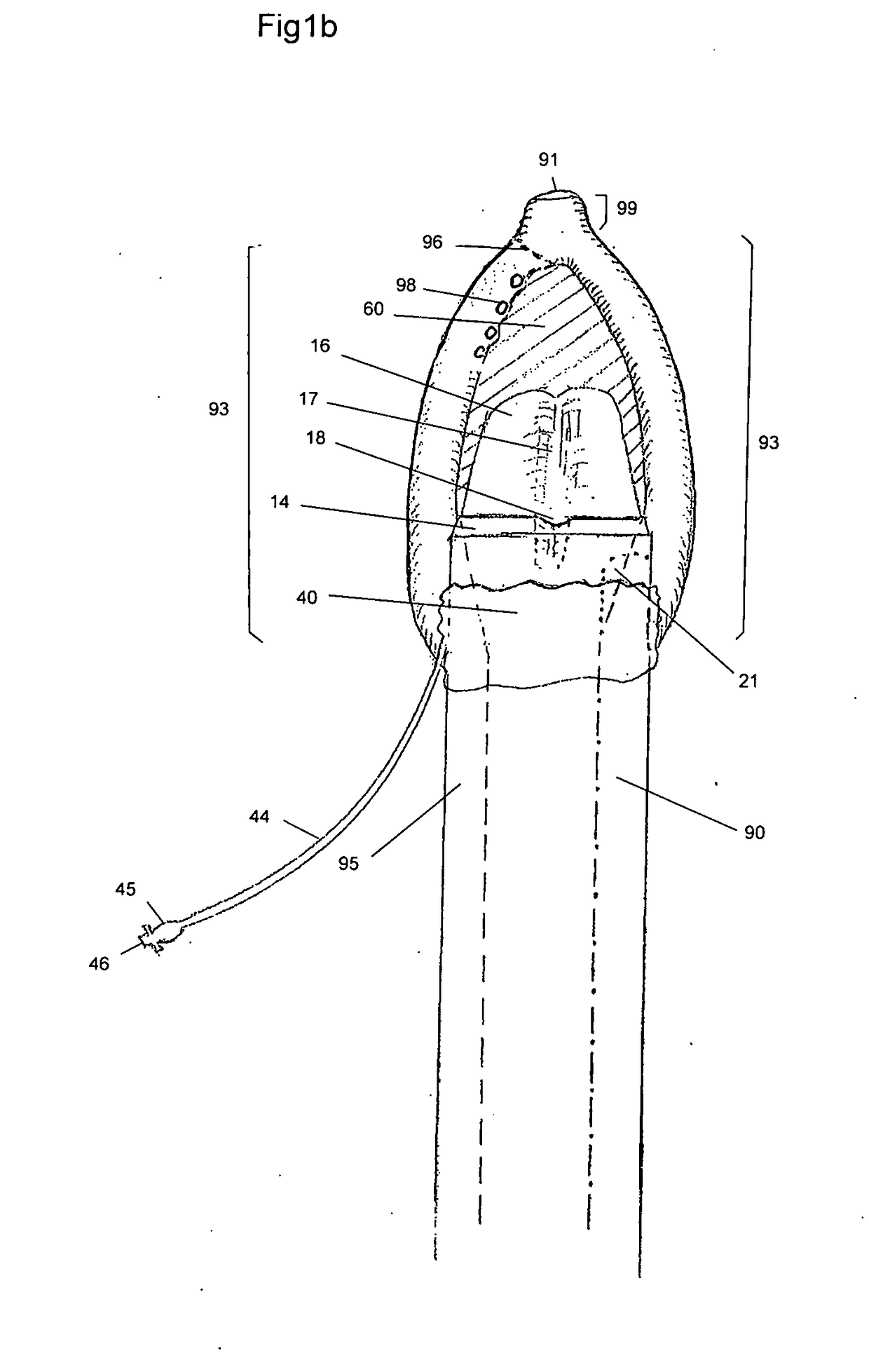 Endotracheal Intubation and Supraglottic Airway Device