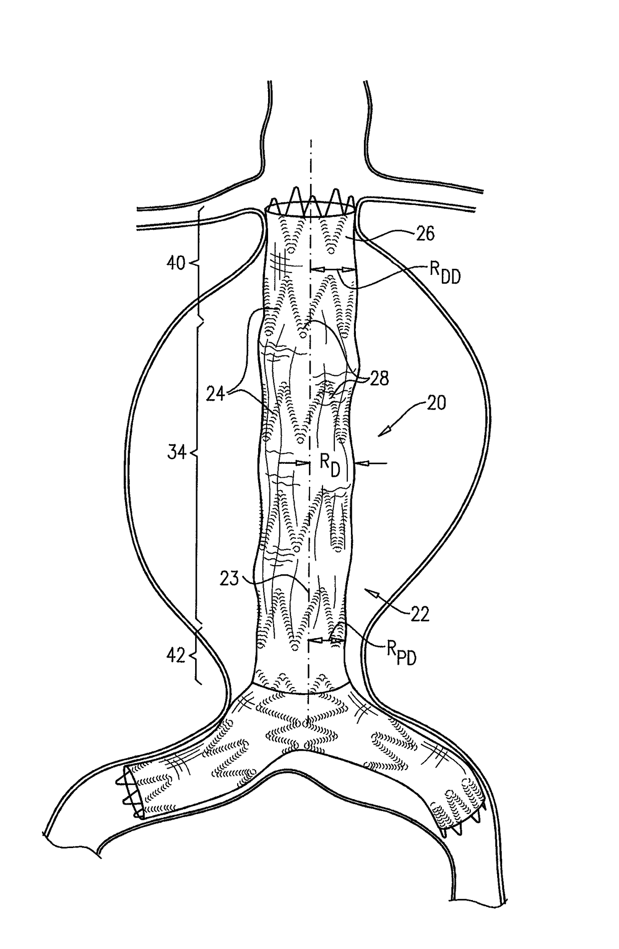 Stent-grafts with post-deployment variable radial displacement