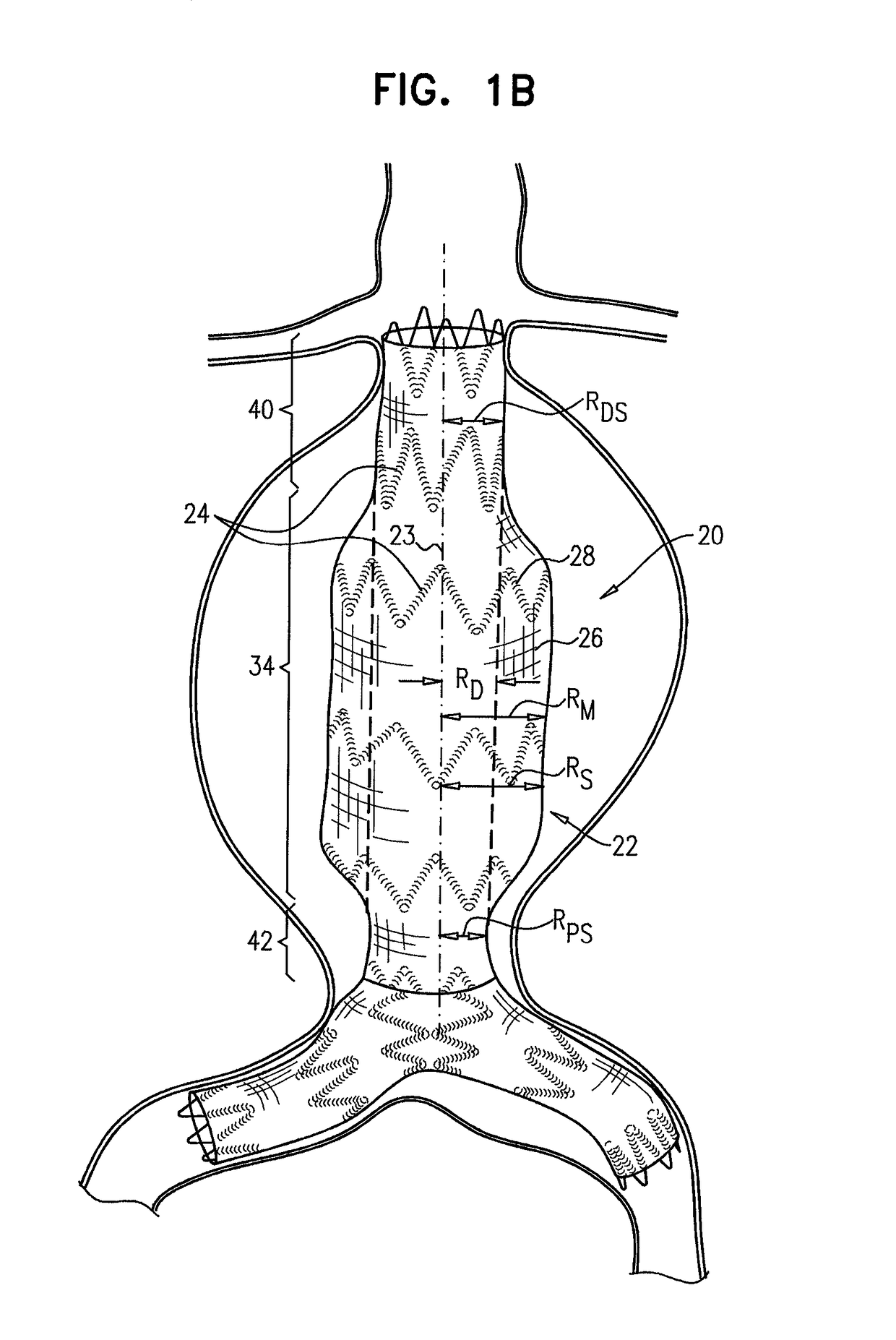 Stent-grafts with post-deployment variable radial displacement