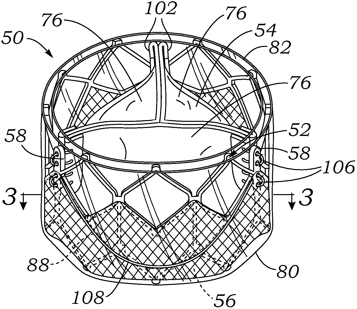 Encapsulated heart valve