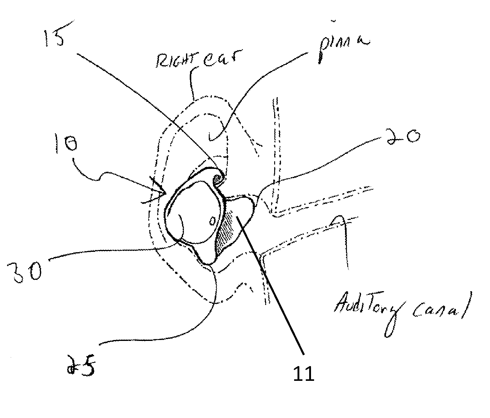 Ear device for improved fit and sound