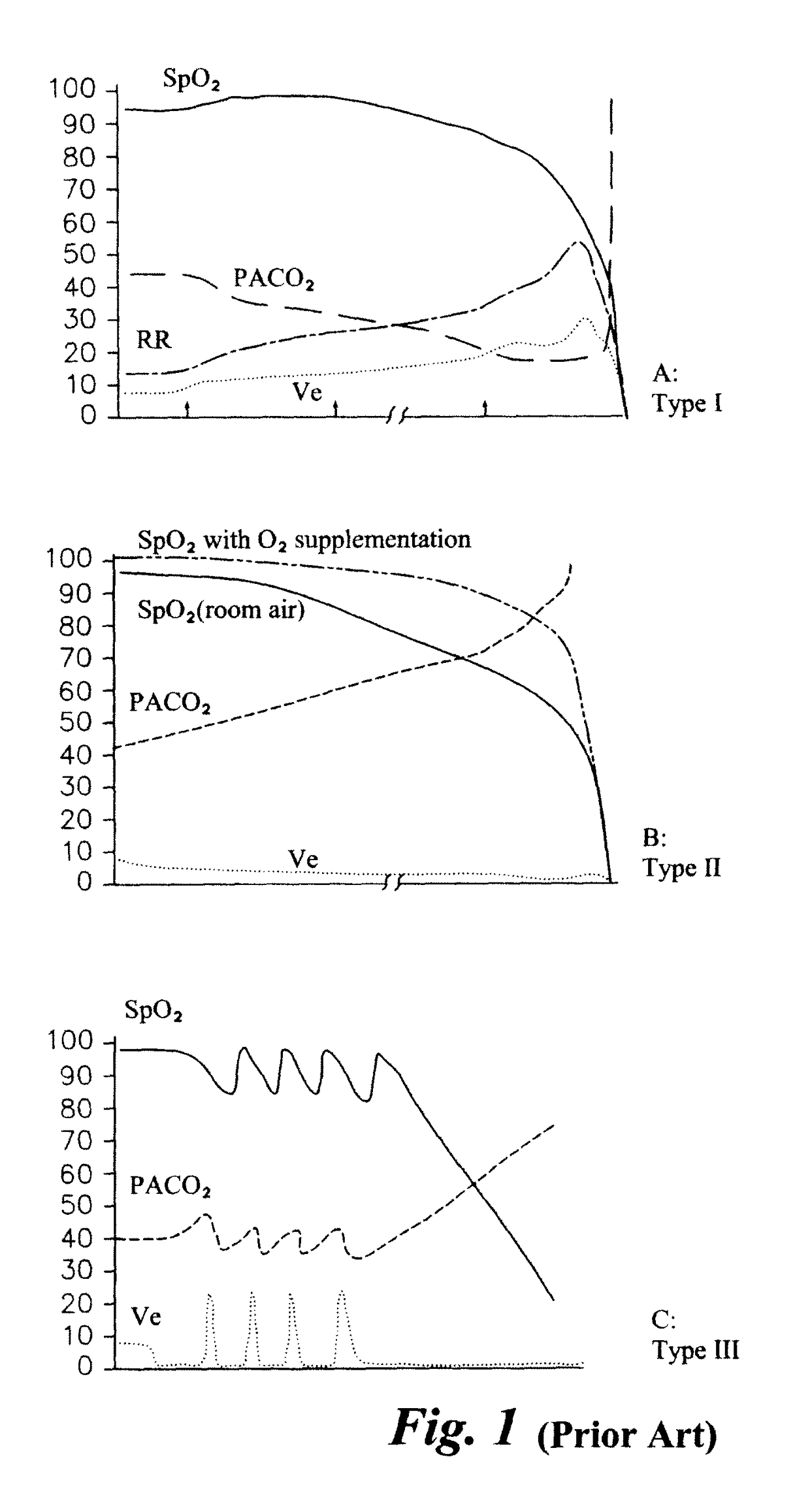 Respiratory stress detection