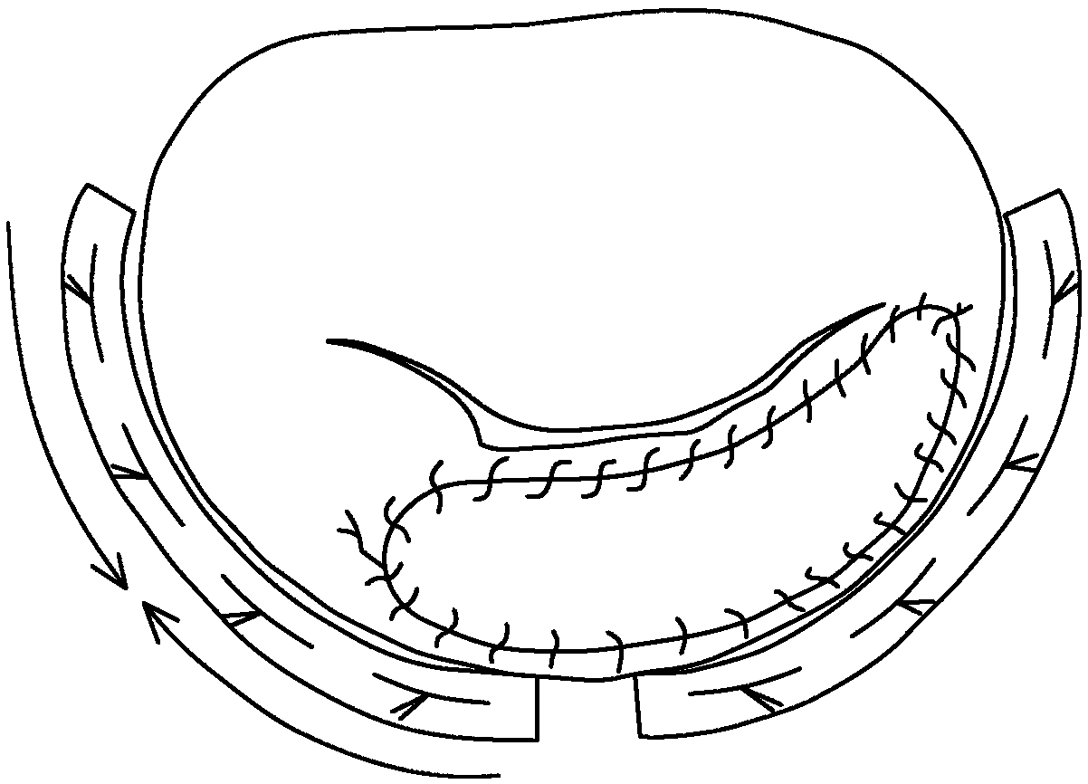 A new type of folded patch integrated into a ring design