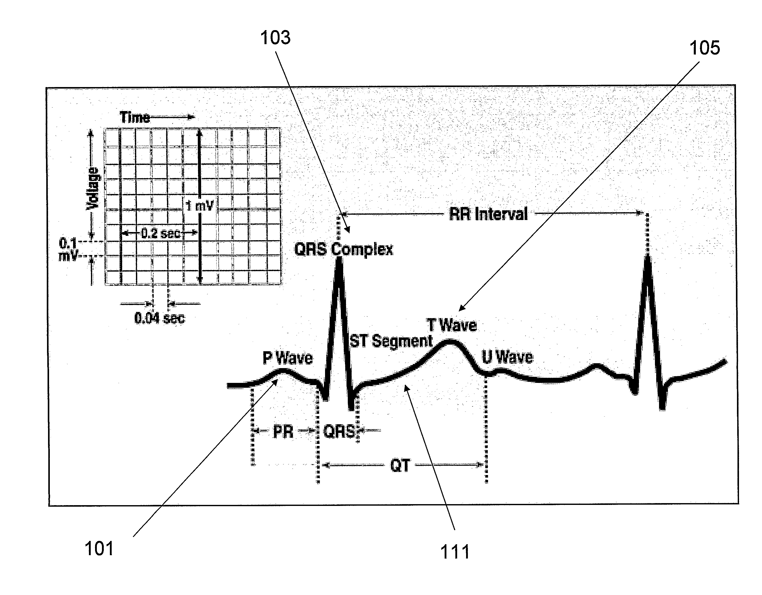 Apparatus and Method for Analysis of High Frequency Qrs Complexes