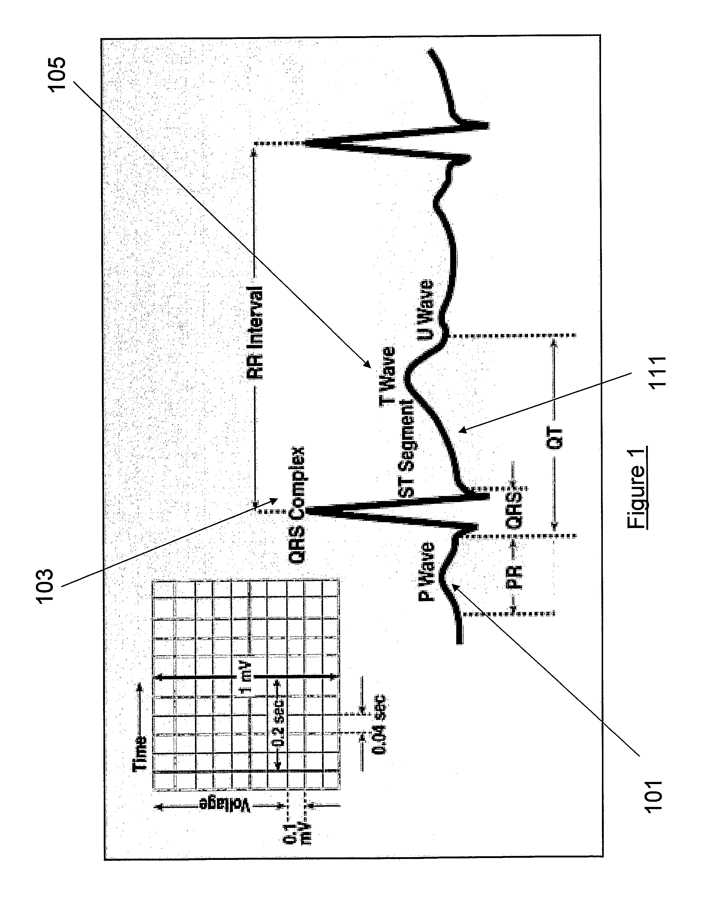 Apparatus and Method for Analysis of High Frequency Qrs Complexes