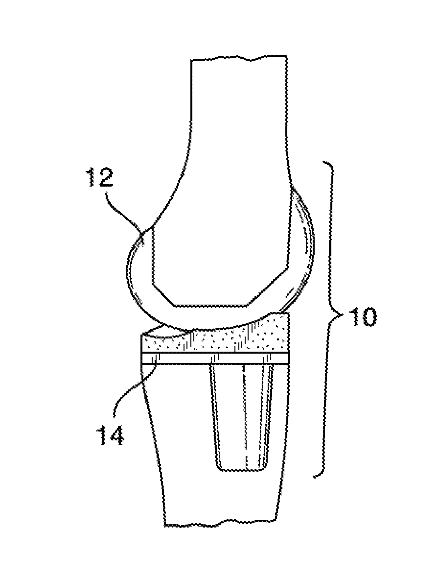 Systems and methods for providing prosthetic components