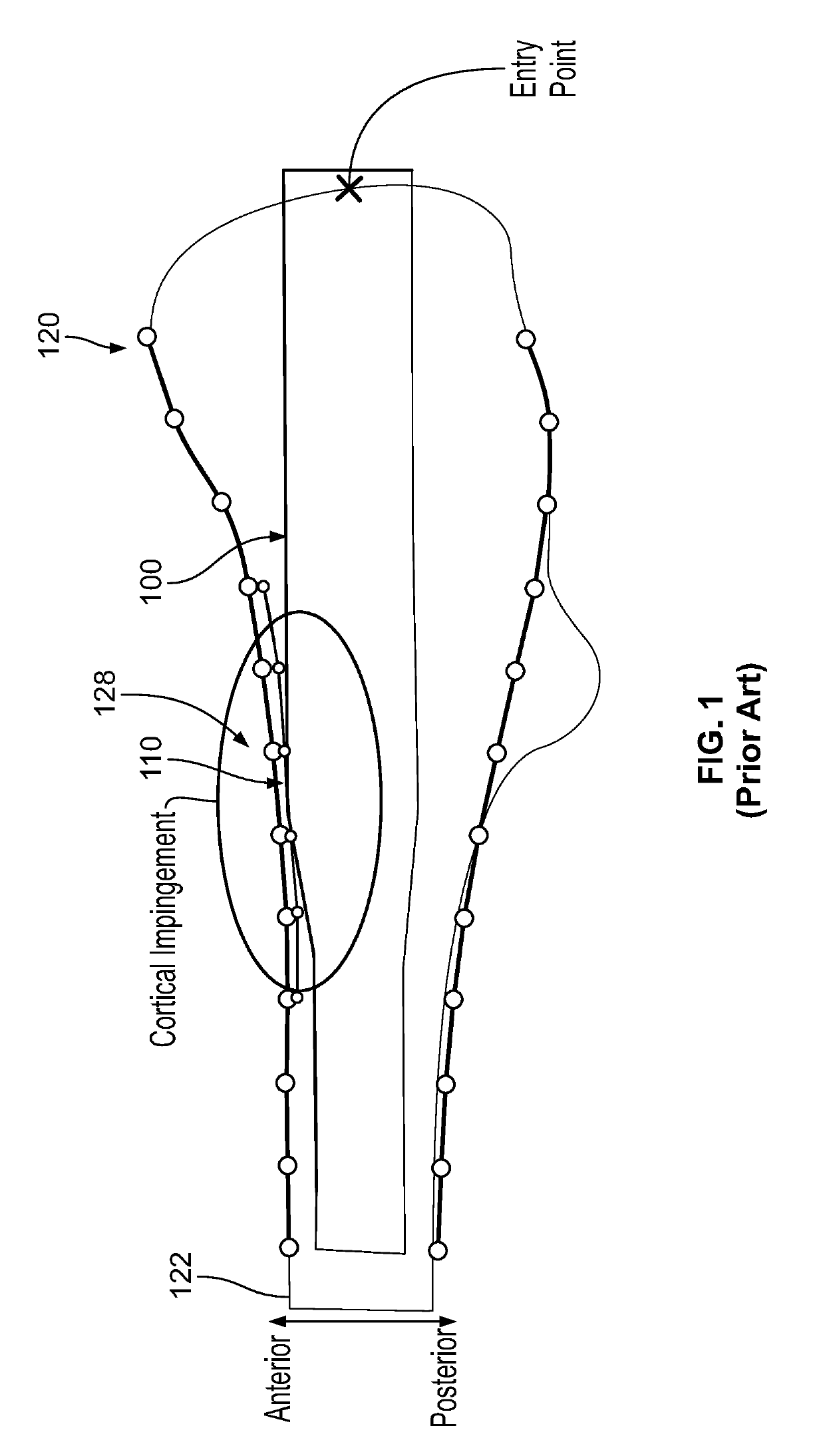 Femoral Nail With Enhanced Bone Conforming Geometry