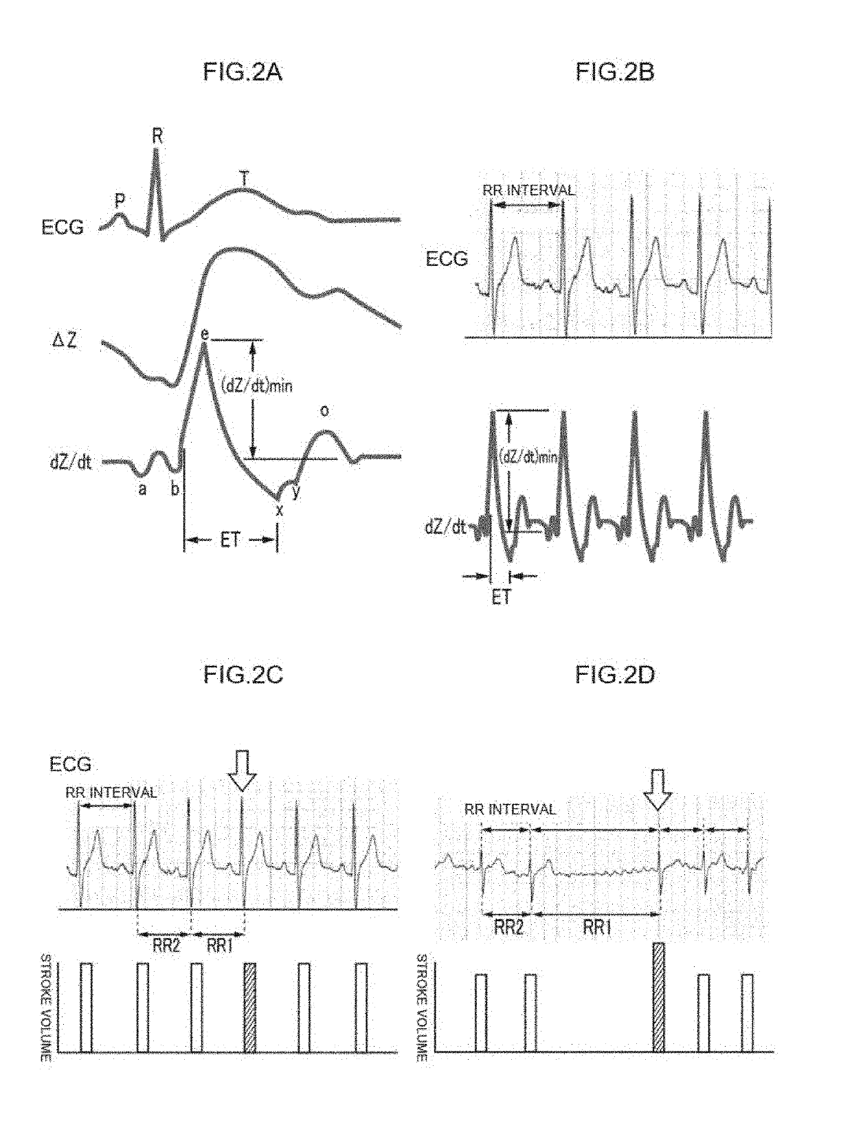 Device for measurement and evaluation of cardiac function on the basis of thoracic impedance