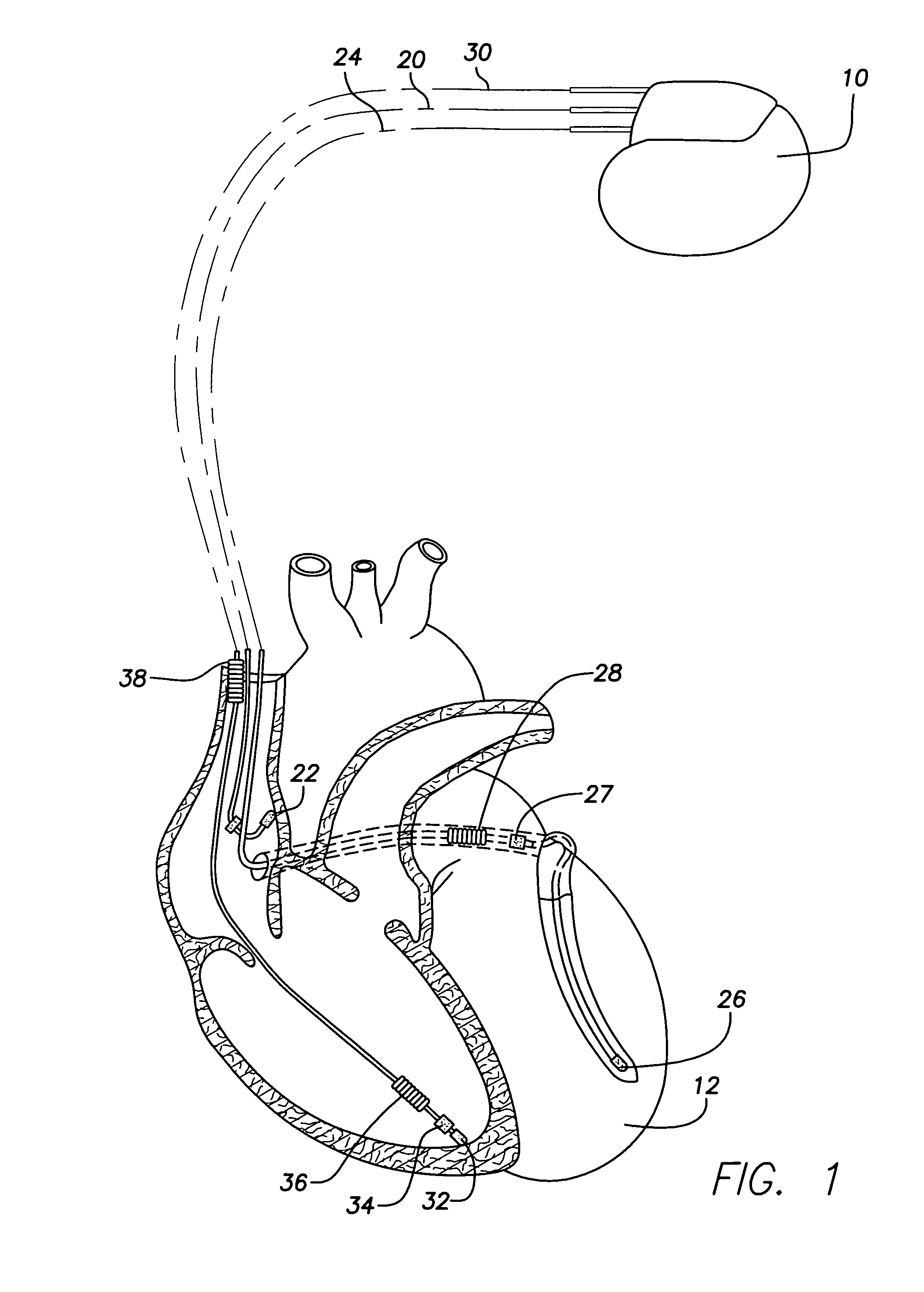 Implantable cardiac stimulation device providing enhanced capture threshold management in the presence of fusion beats and method