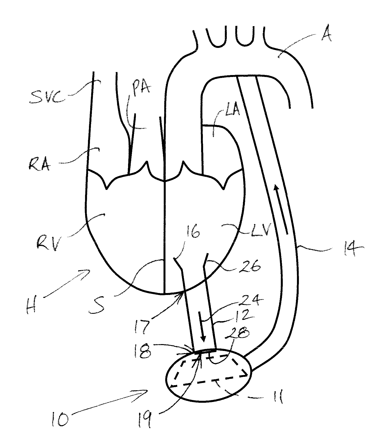 Heart assist device, cannula and filter therefor