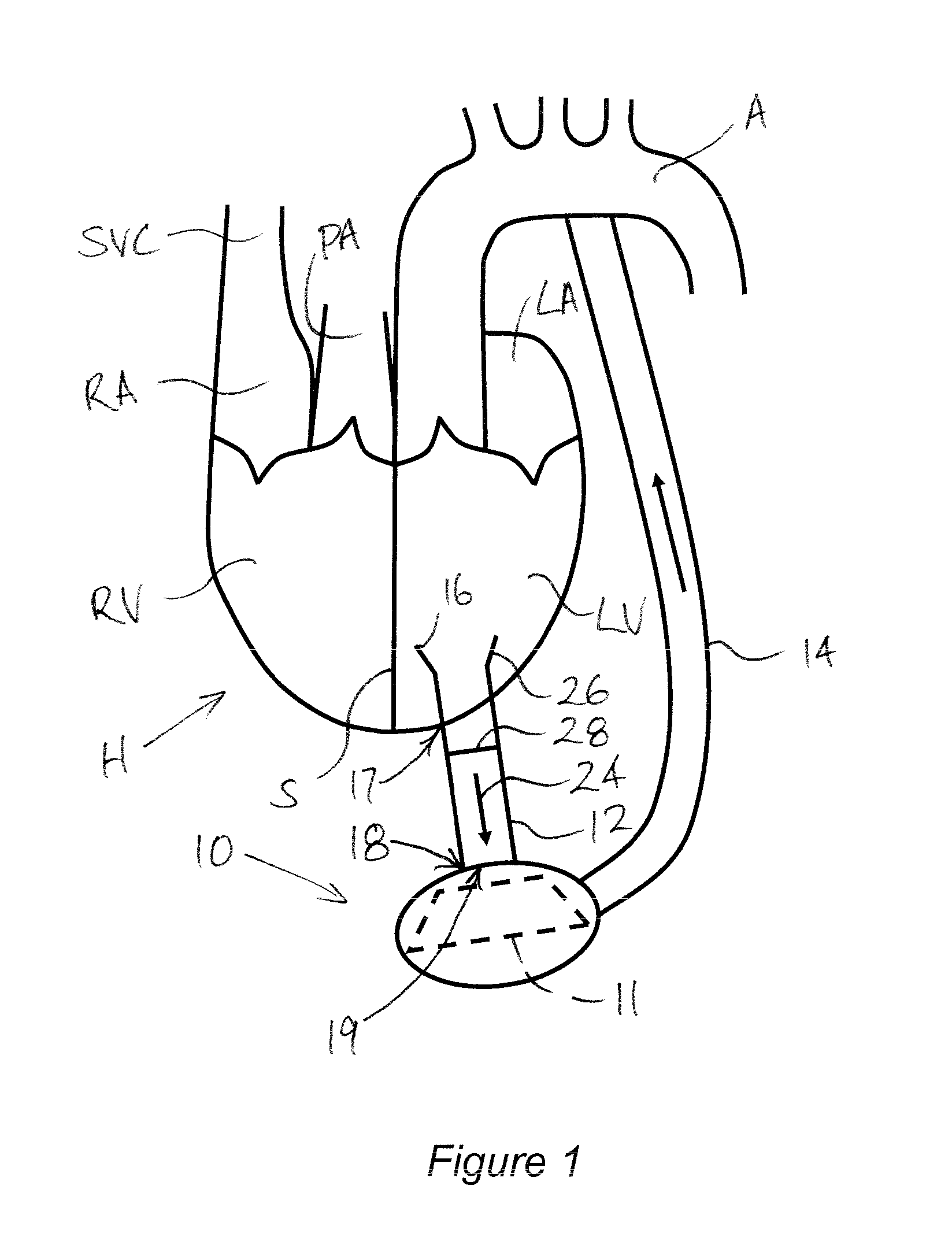 Heart assist device, cannula and filter therefor