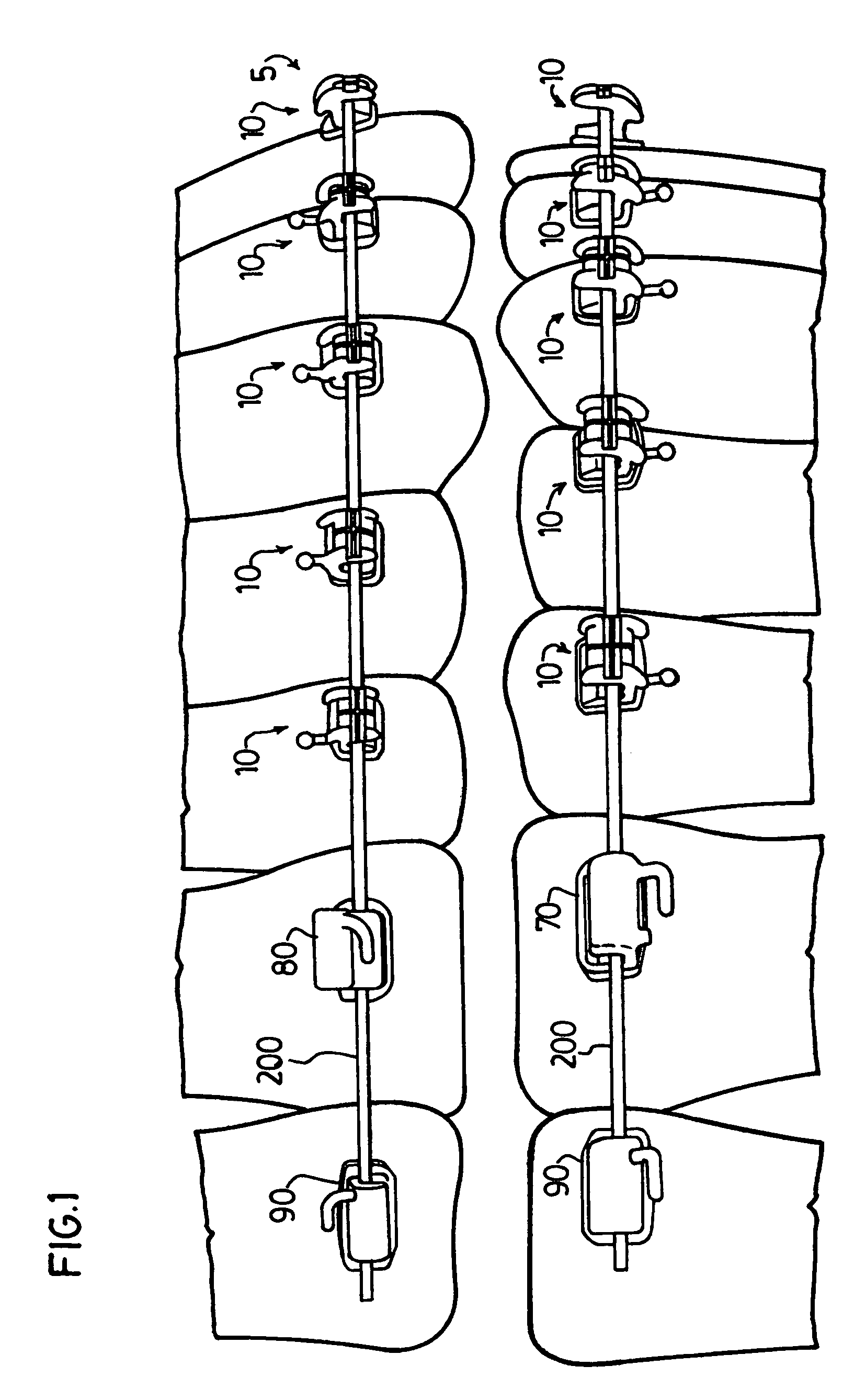 Orthodontic bracket system