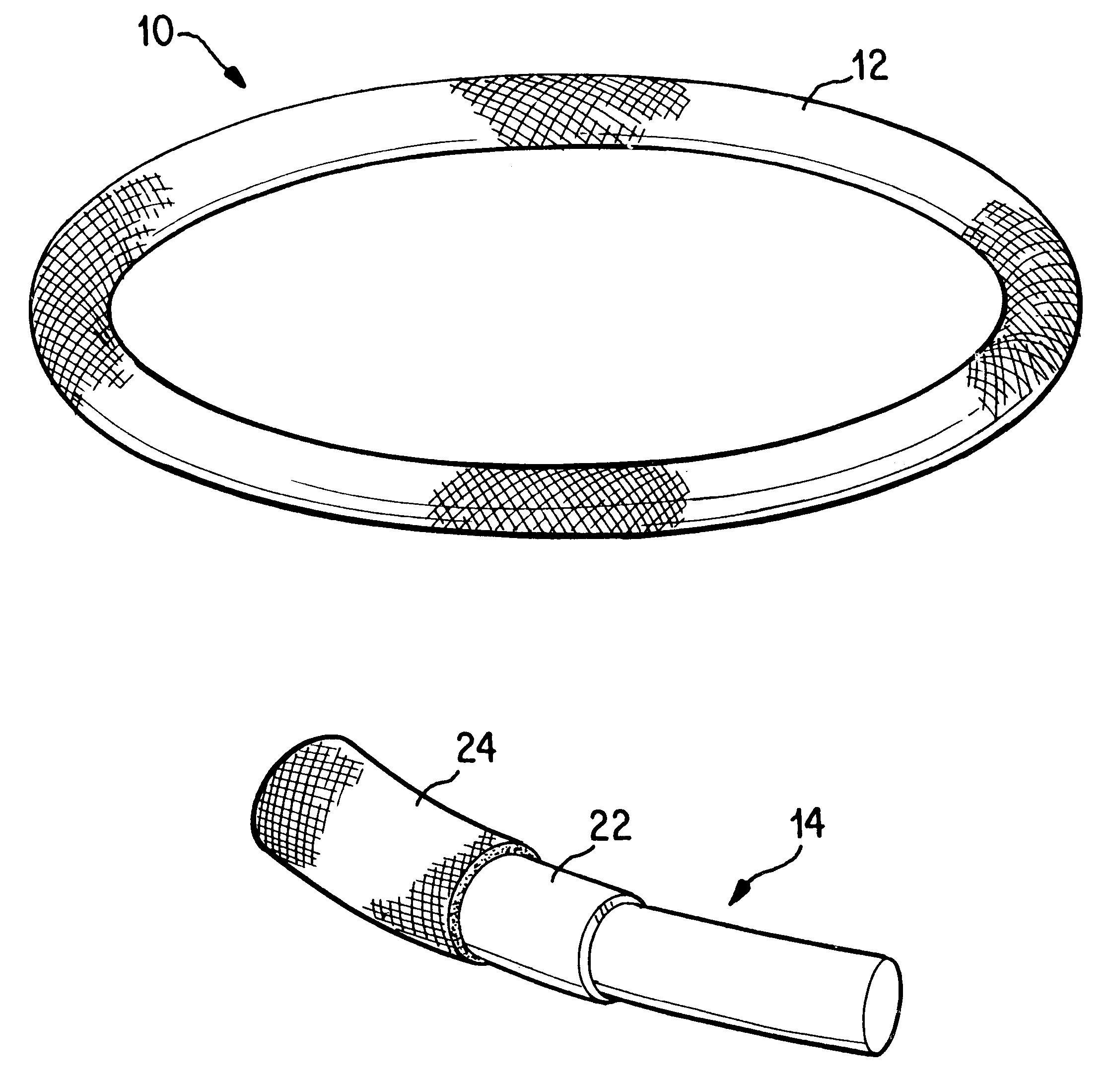 Antimicrobial annuloplasty ring having a biodegradable insert