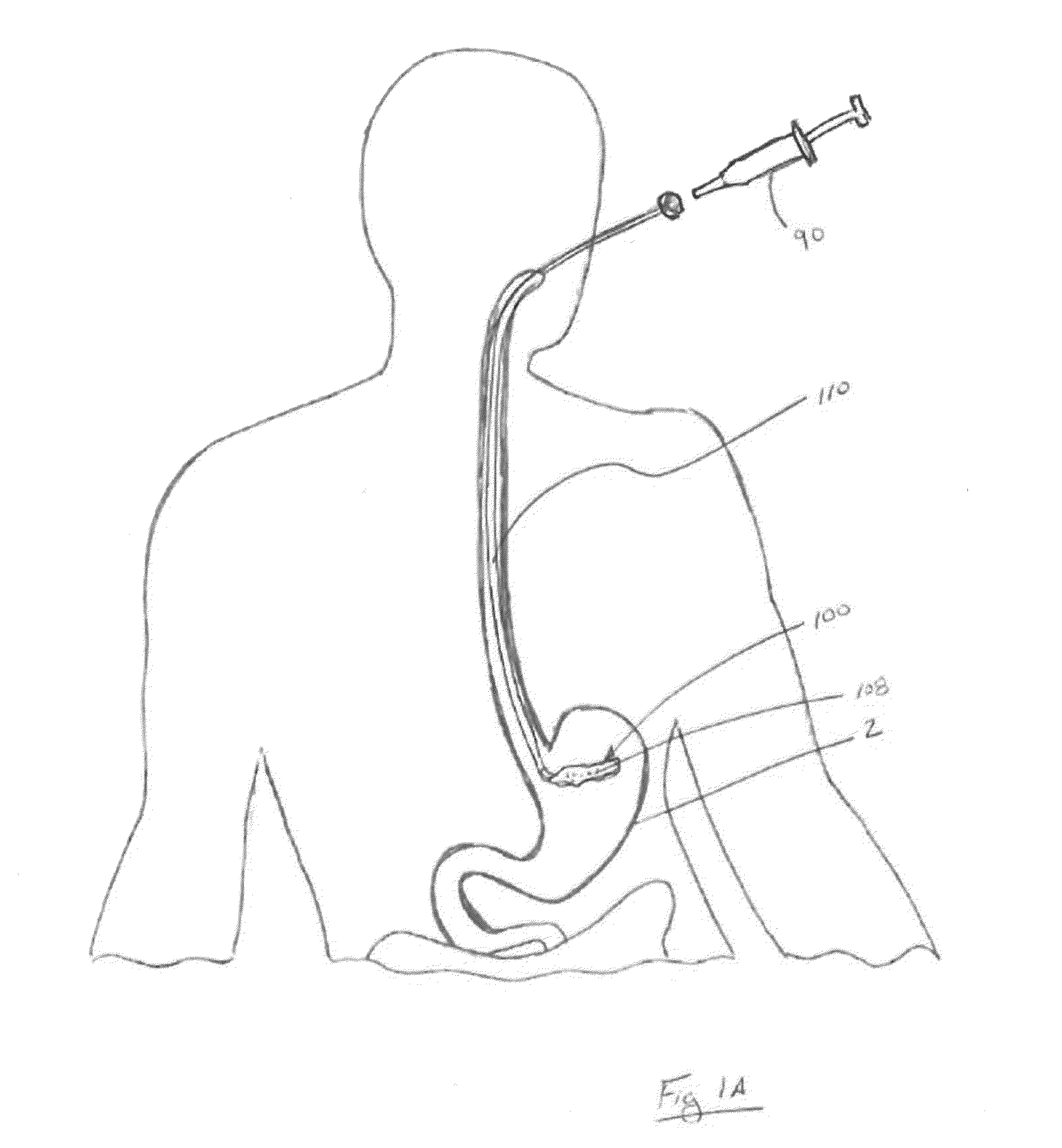 Methods and devices for deploying and releasing a temporary implant within the body