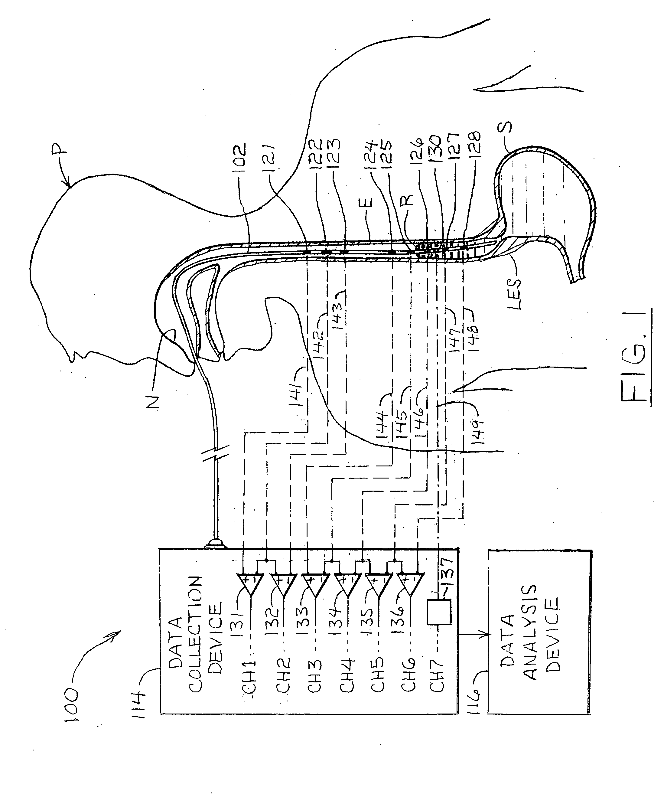 Esophageal waveform analysis for detection and quantification of reflux episodes