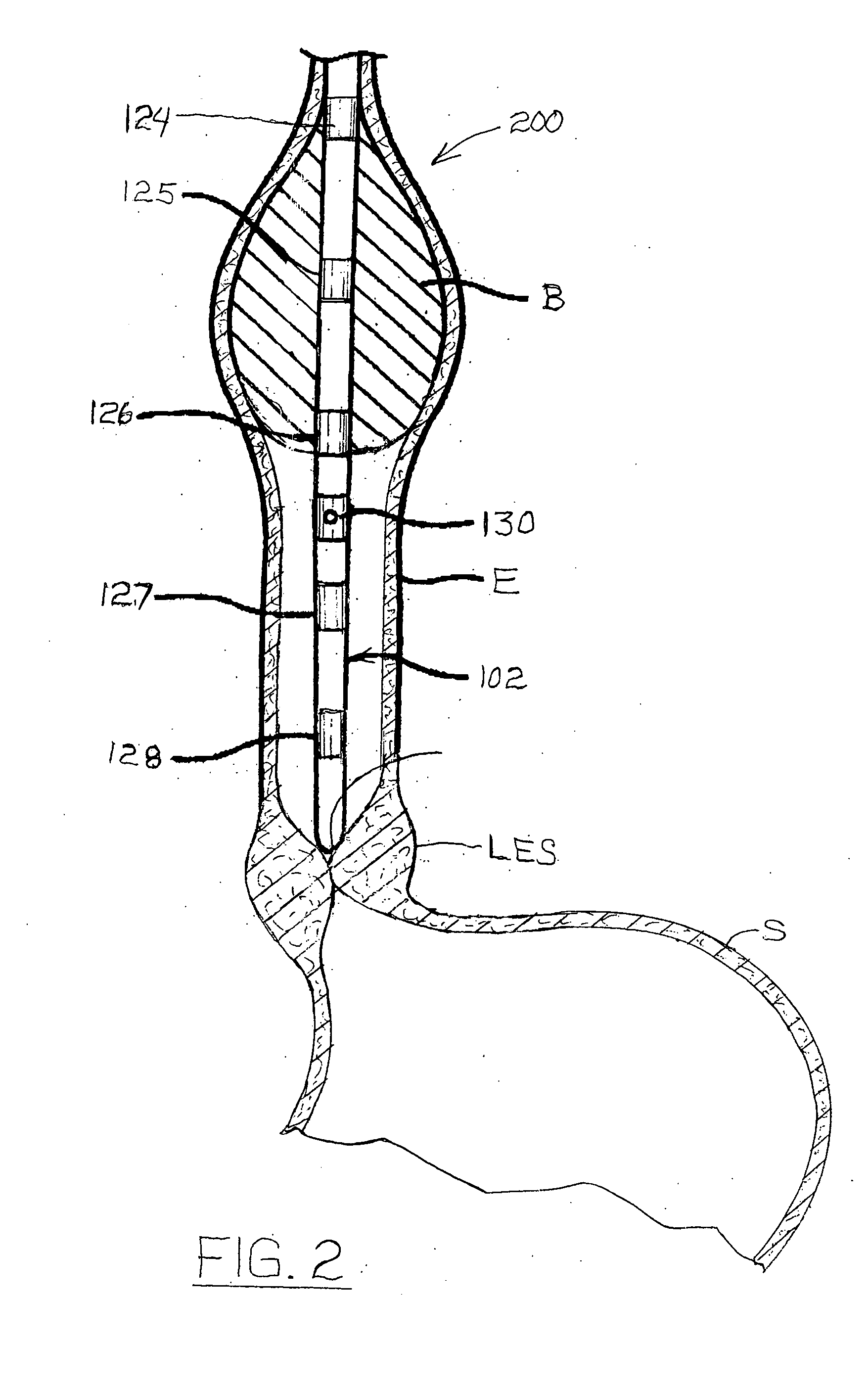 Esophageal waveform analysis for detection and quantification of reflux episodes