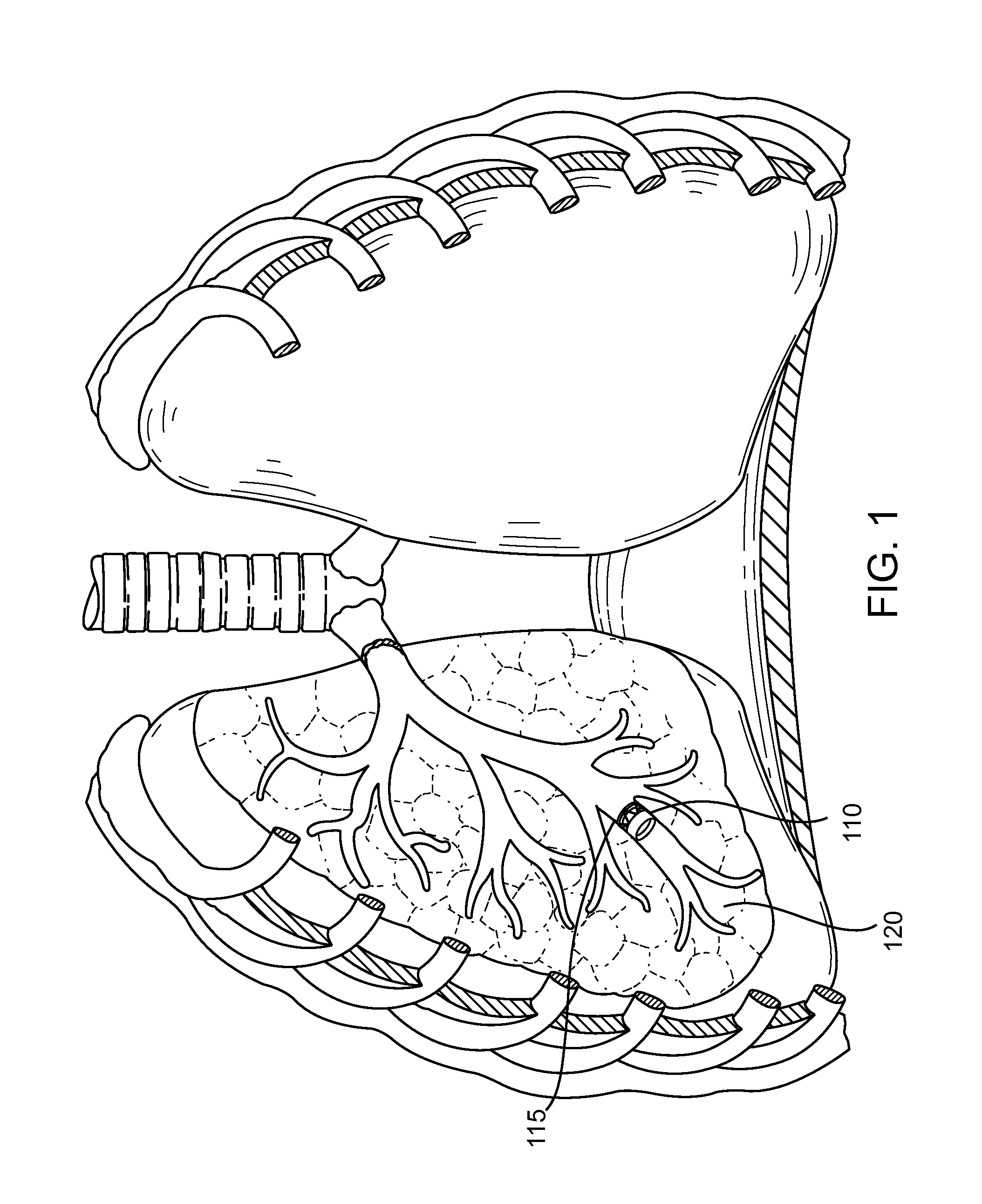 Implanted bronchial isolation devices and methods