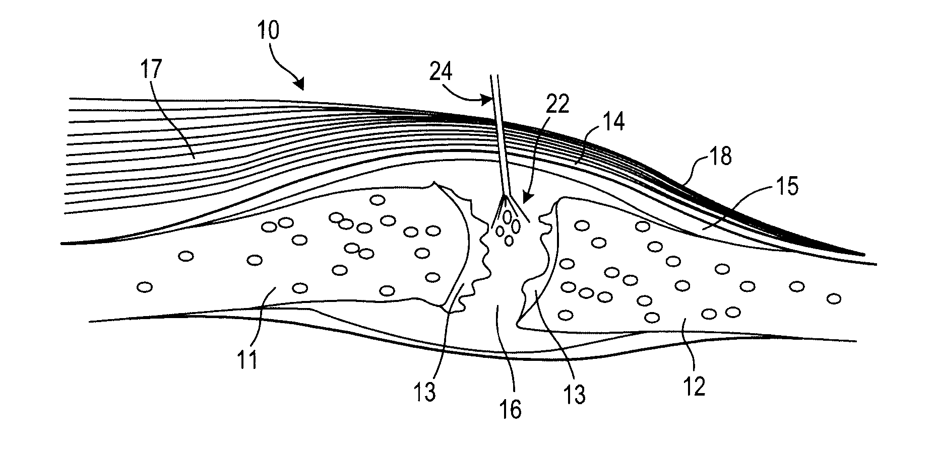 Flowable composition that sets to a substantially non-flowable state