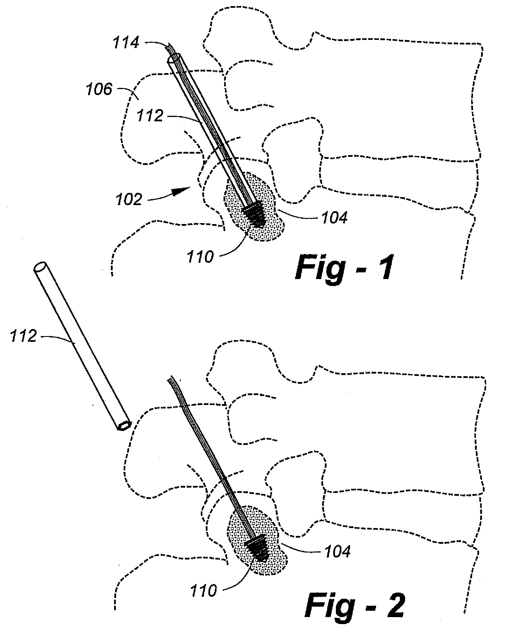 Dynamic/static facet fixation device and method