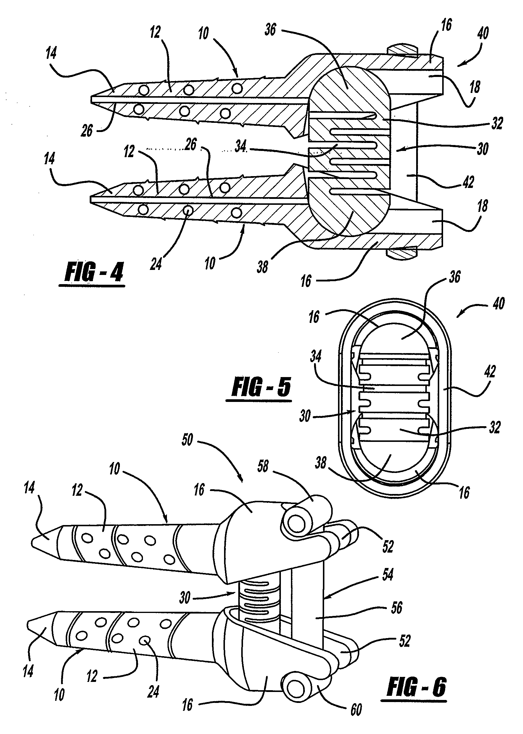 Method for Vertebral Disc Annular Fibrosis Tensioning and Lengthening