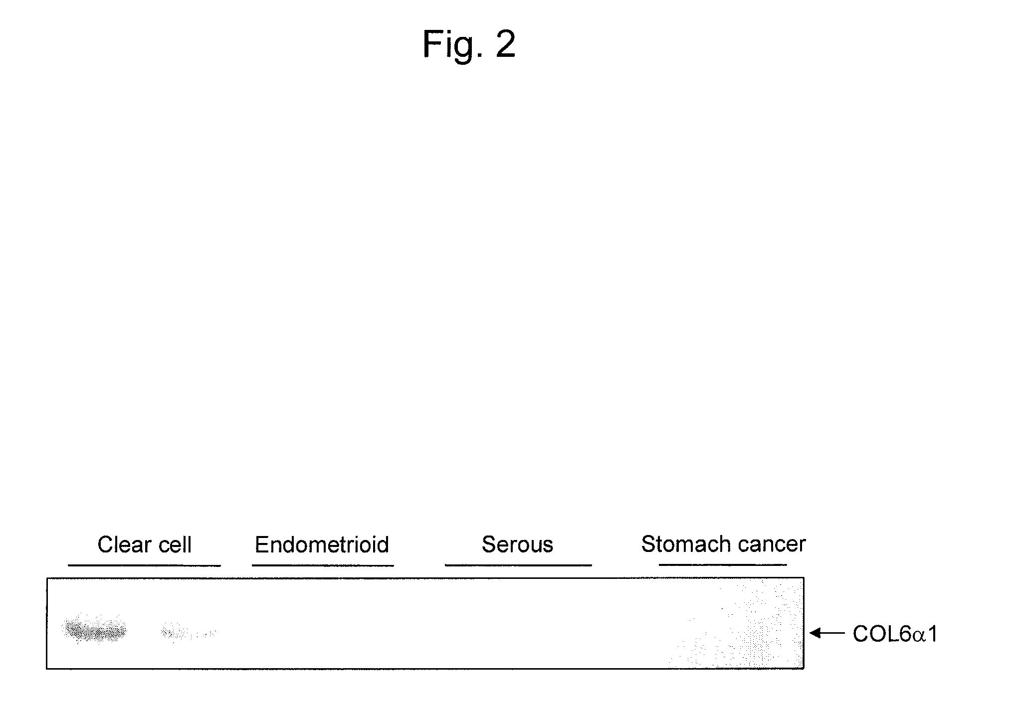 Epithelial ovarian cancer differentiation marker