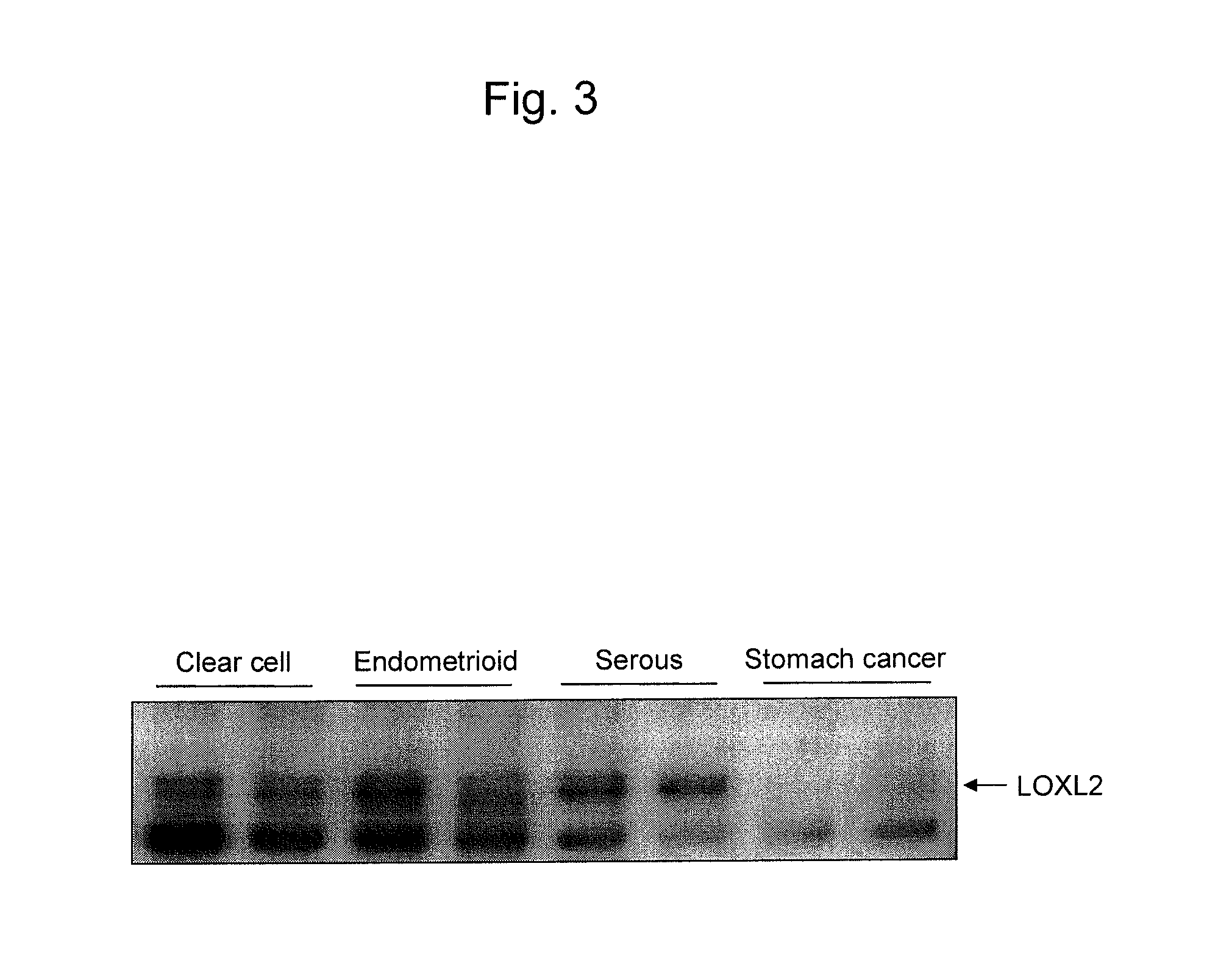 Epithelial ovarian cancer differentiation marker