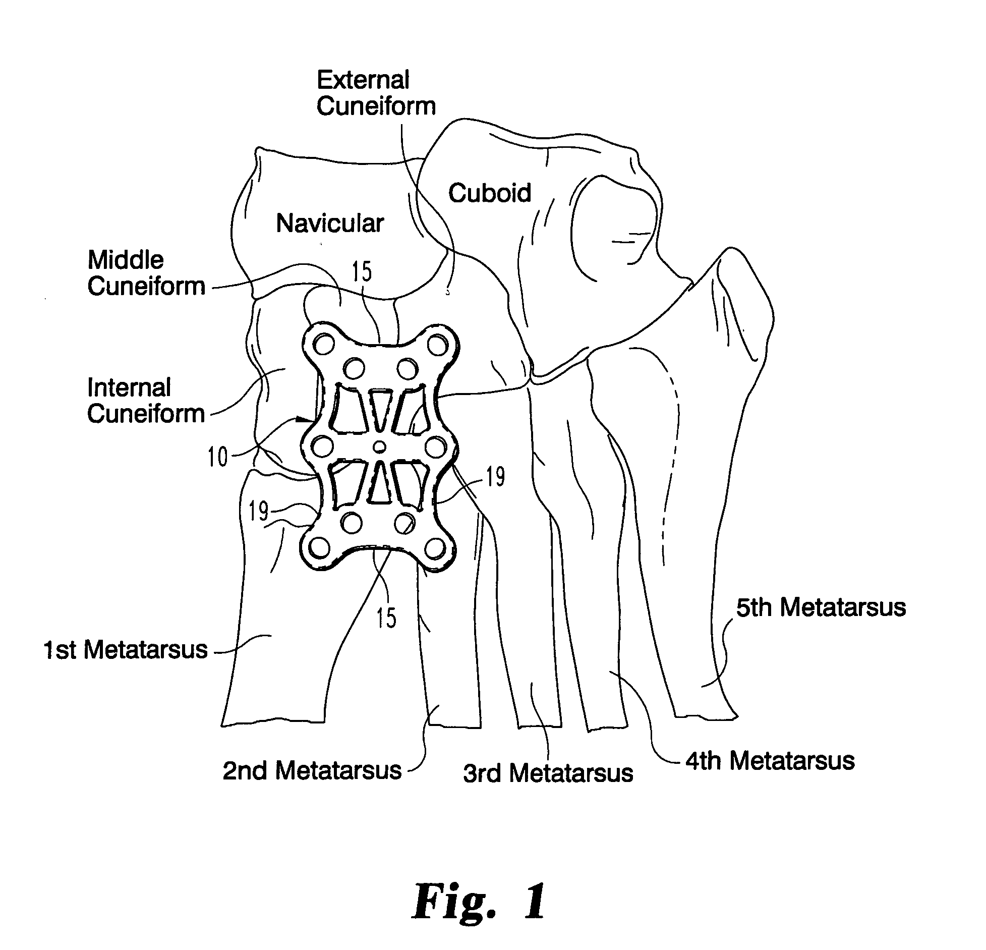 Mid-foot fixation plate