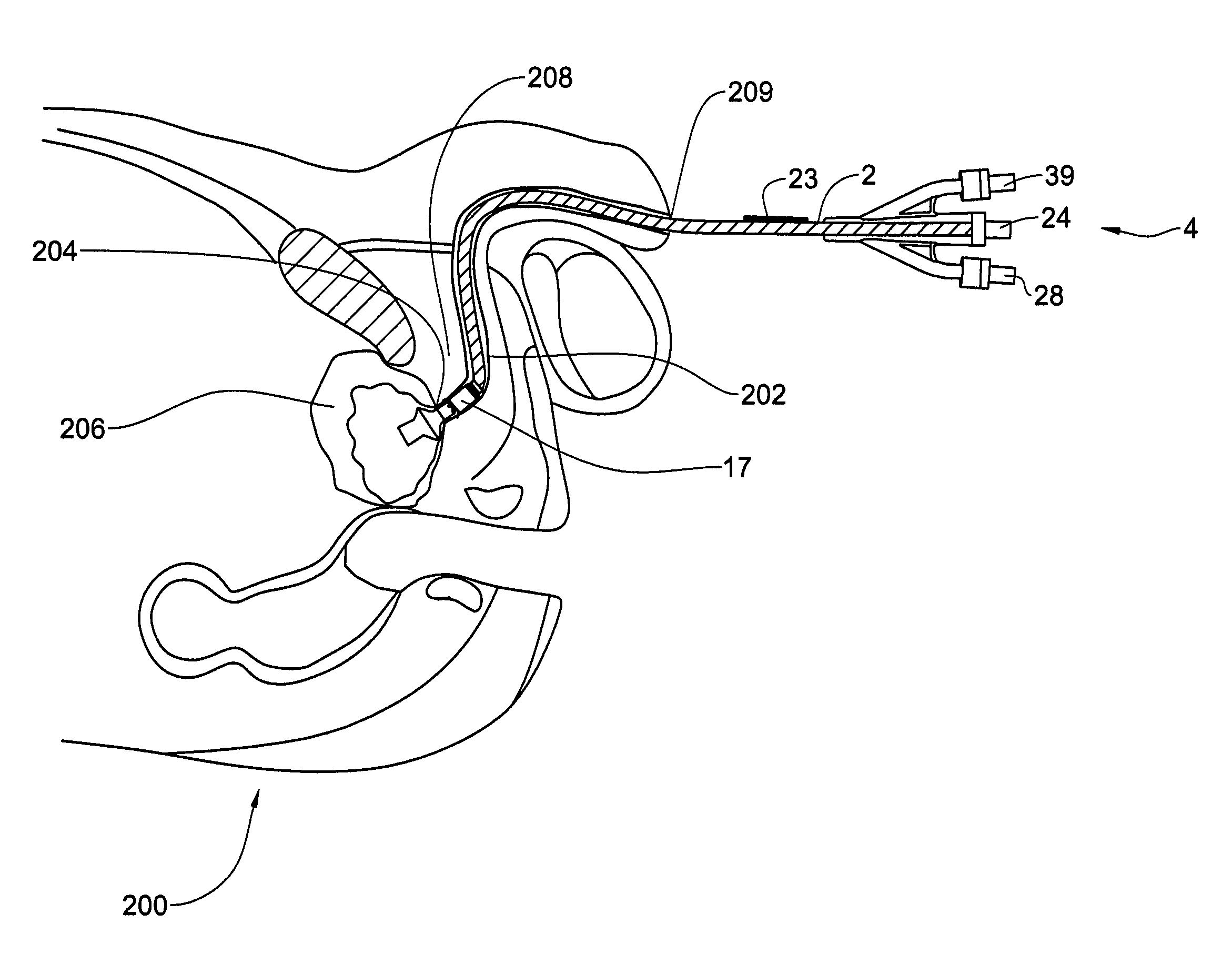 Urethral anastomosis device