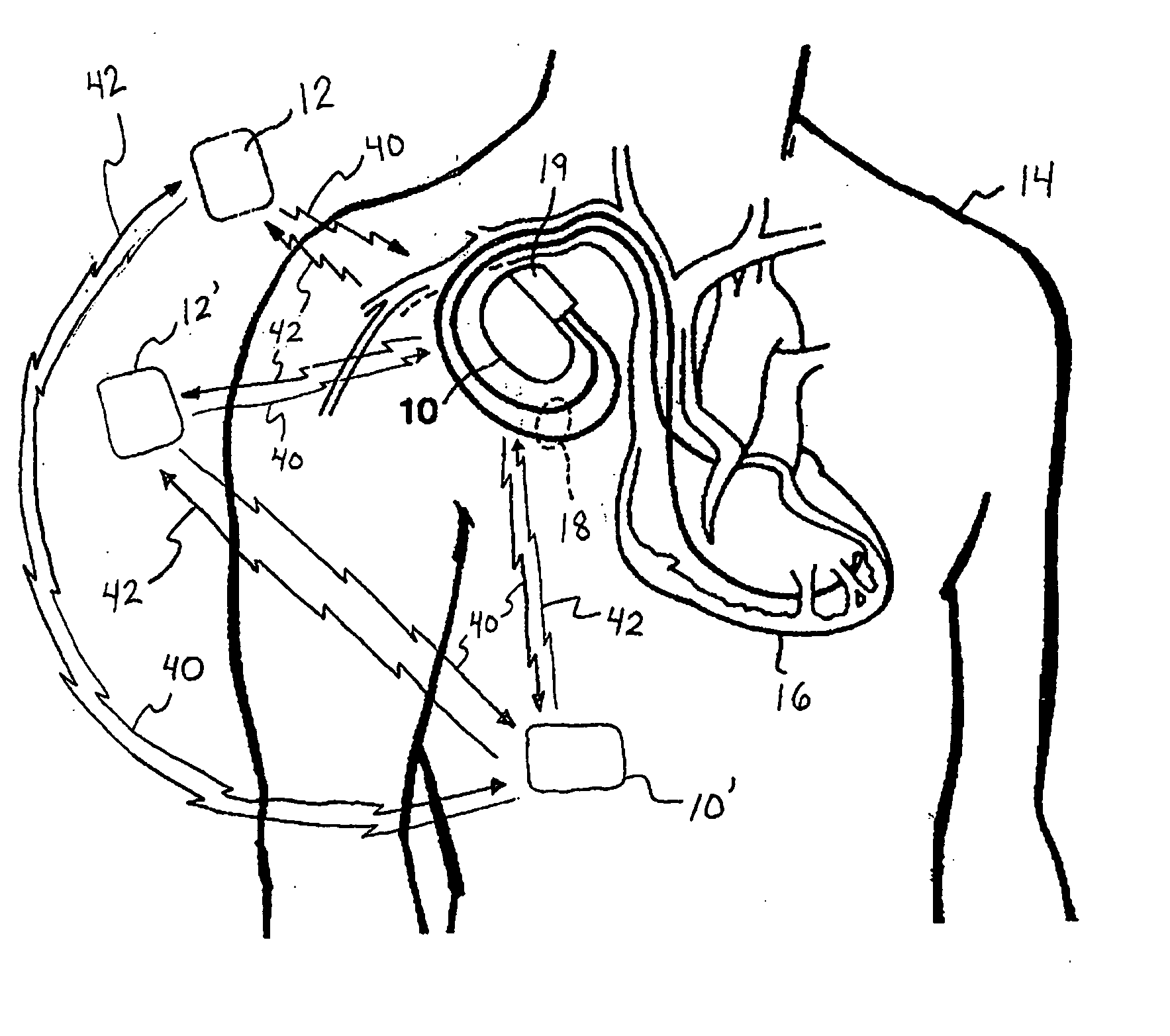 Protocol implementation for telemetry communications involving implantable medical devices