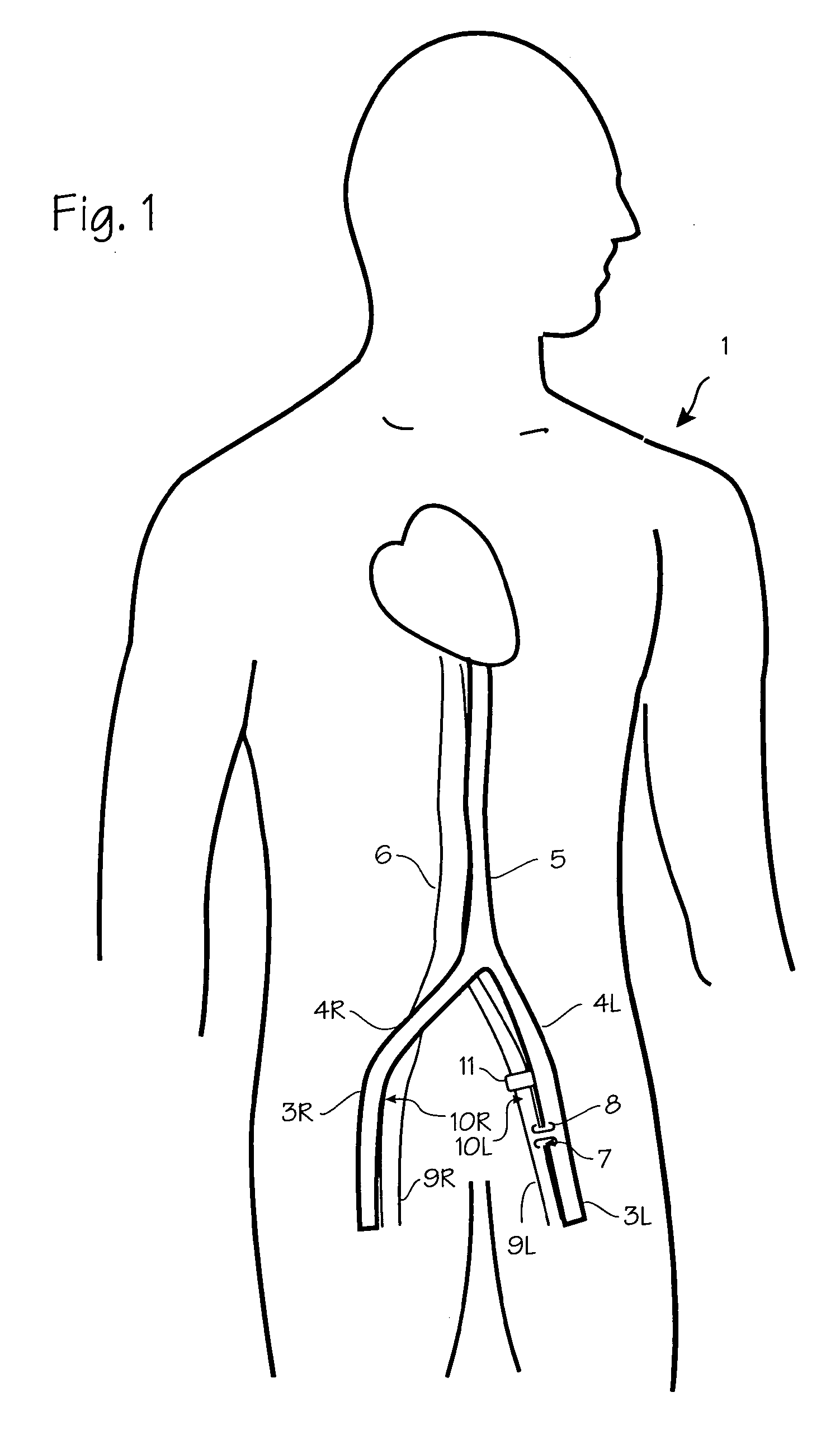 Method of treating COPD with artificial arterio-venous fistula and flow mediating systems