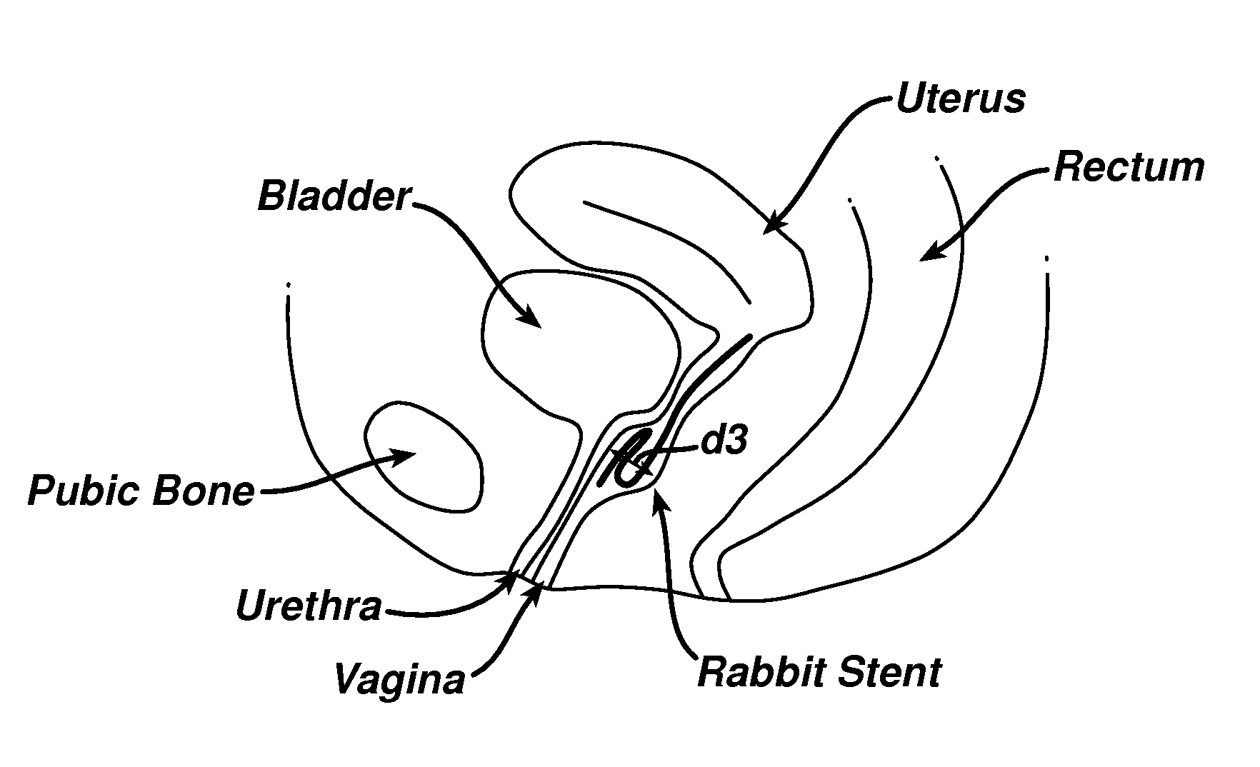 Method for treating urinary incontinence