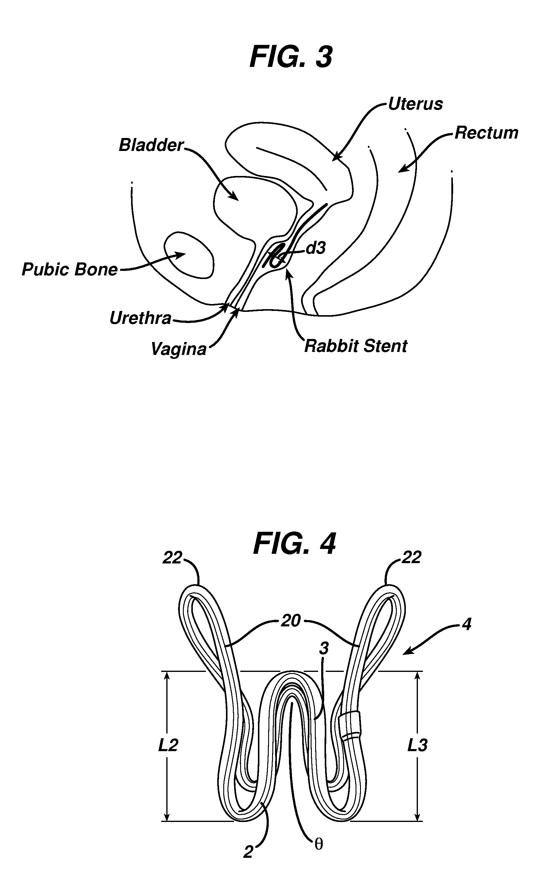 Method for treating urinary incontinence