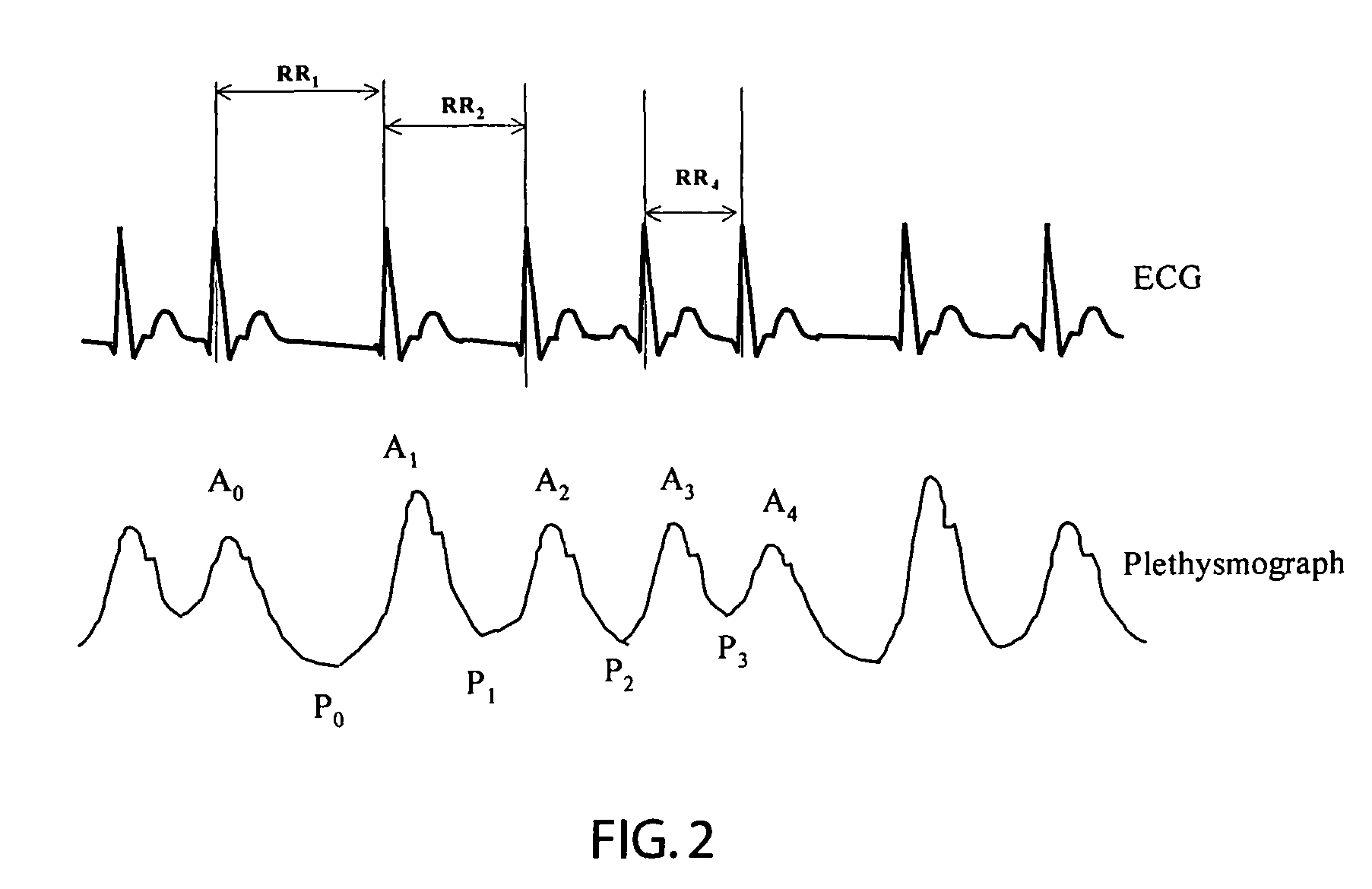 Atrial fibrillation detection using SPO2