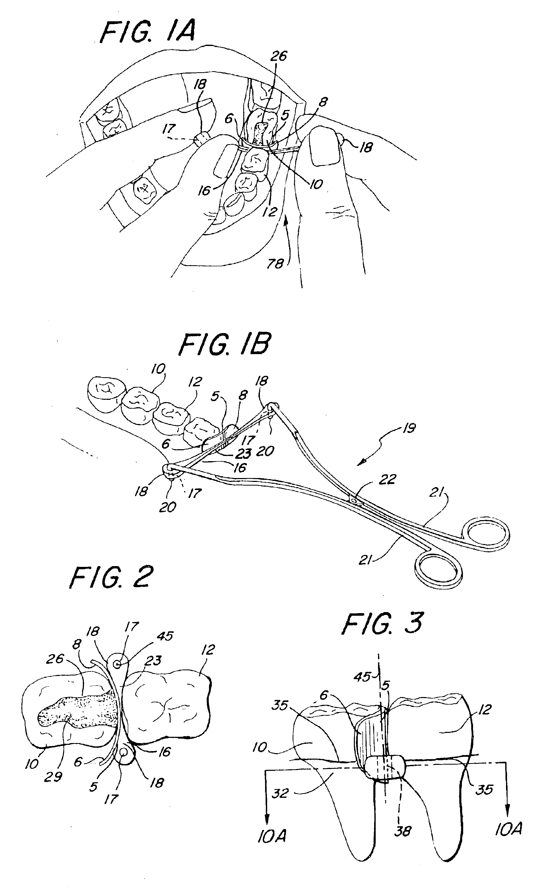 Interproximal matrix with elastomeric wedge