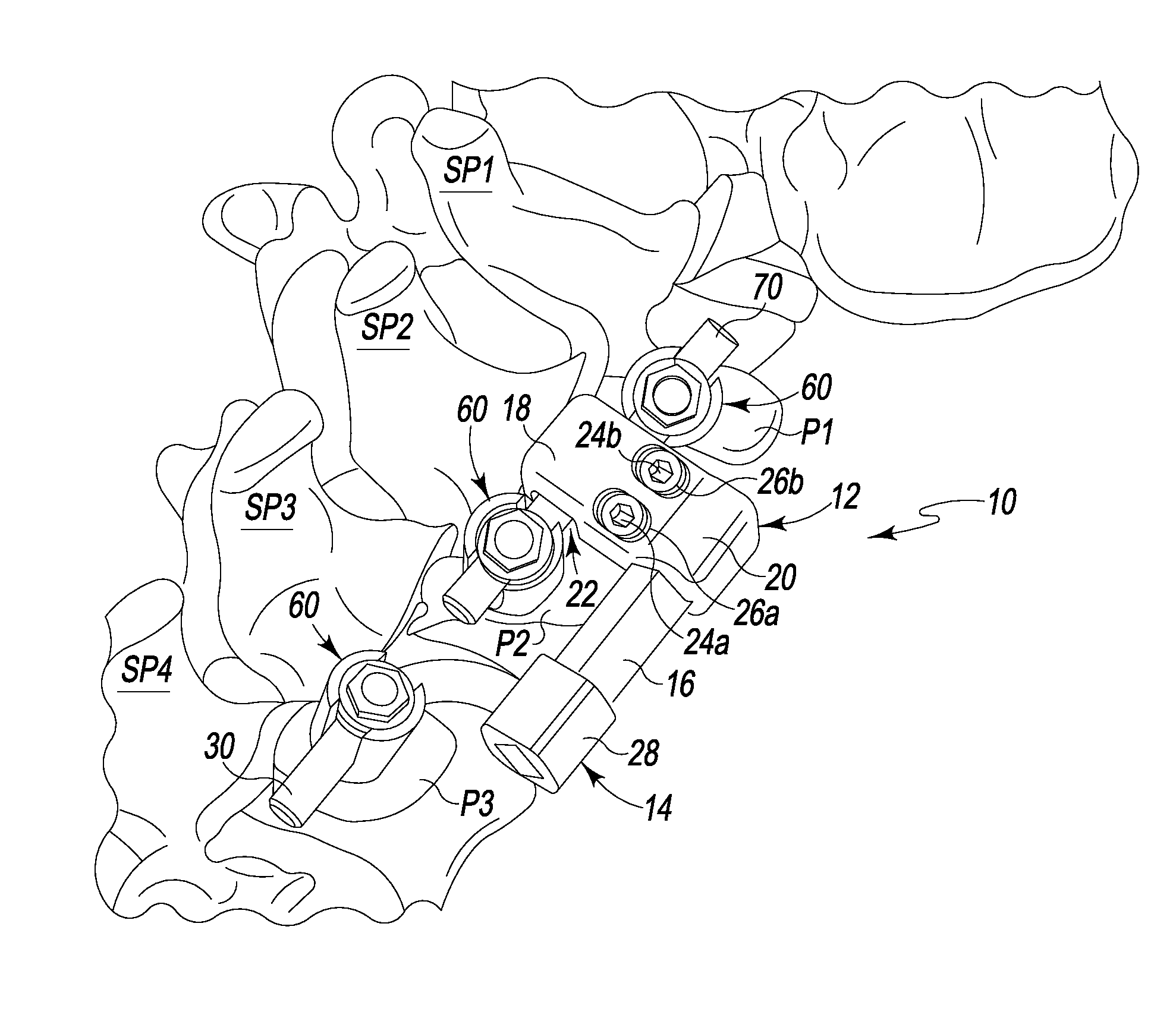 Supplementary Spinal Fixation/Stabilization Apparatus With Dynamic Inter-Vertebral Connection