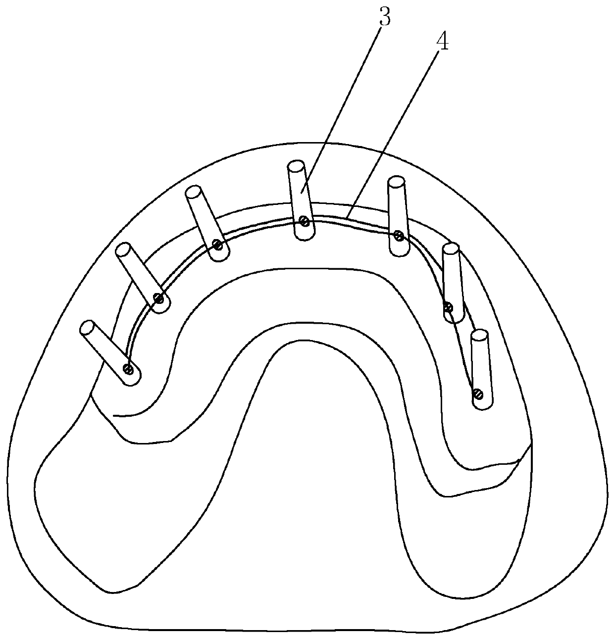 Making method of edentulous jaw precise tooth transfer model