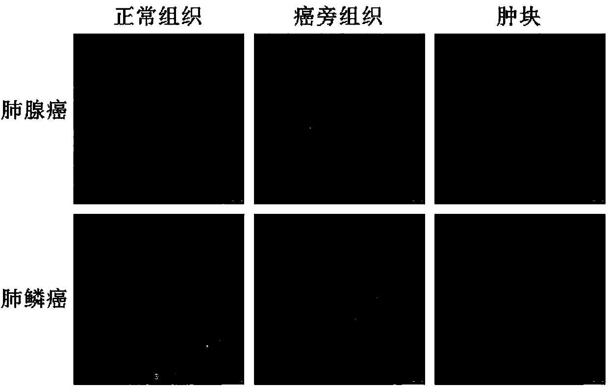 Method for detecting lung cancer typing