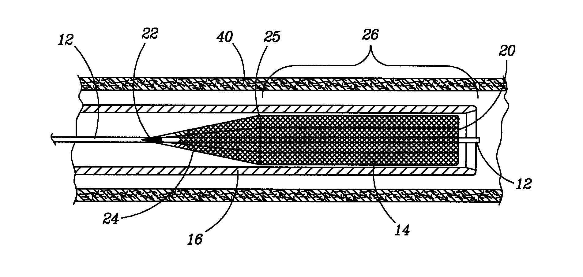 Retractable Flow Maintaining Stent