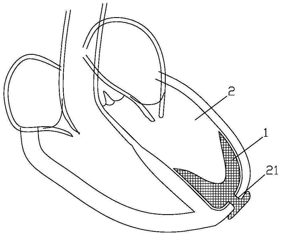 Woven type volume reduction device