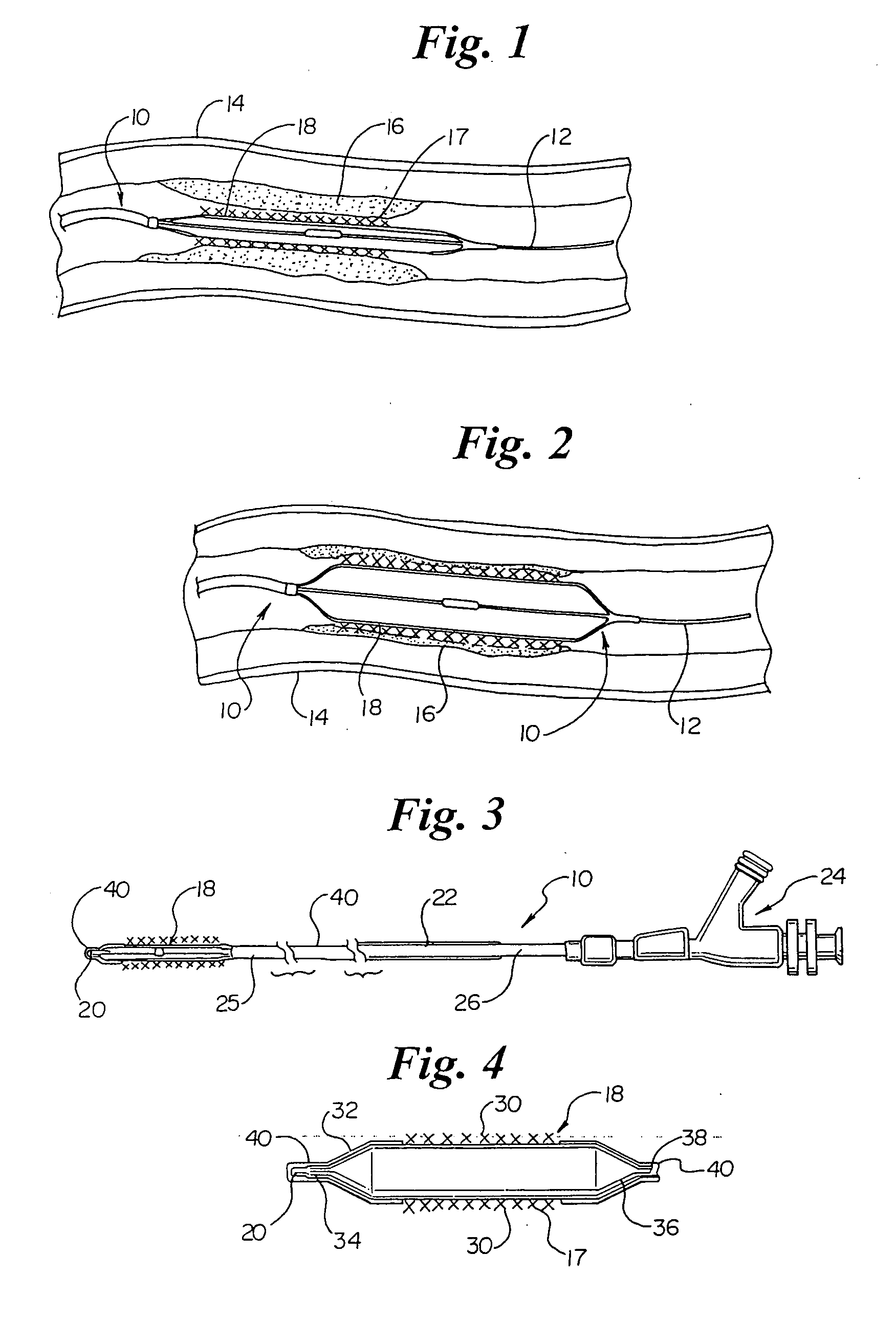 Selective coating of a balloon catheter with lubricious material for stent deployment