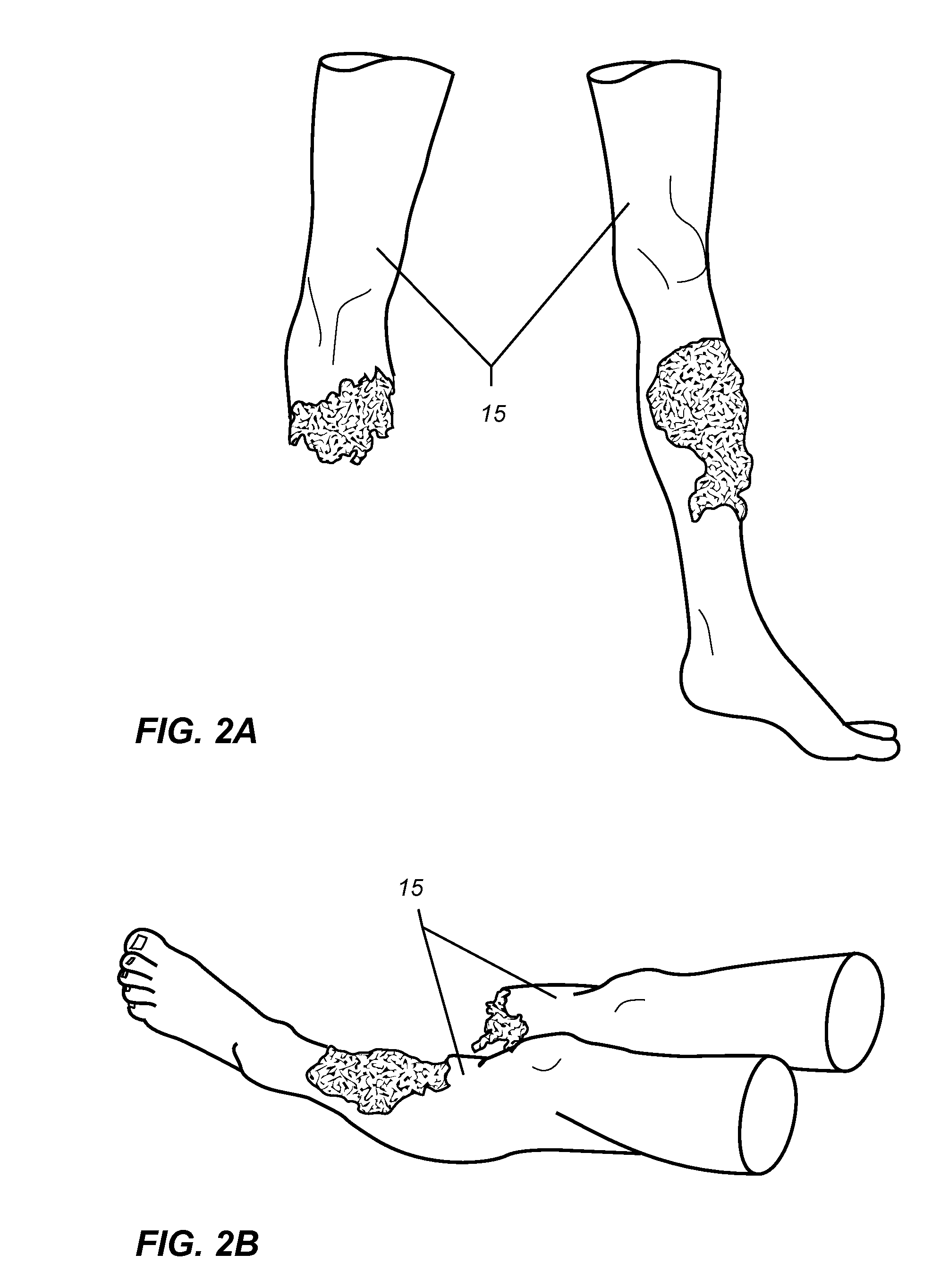 Removable tension-pneumothorax-simulator cartridge for use with a patient simulating mannequin