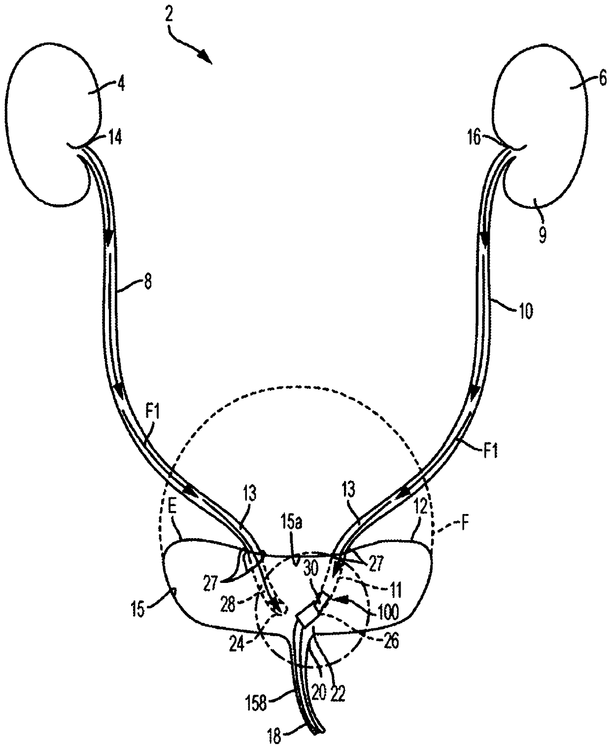 Indwelling pump for facilitating removal of urine from the urinary tract