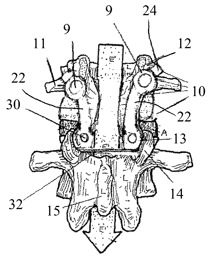 Posterior-medial facet support assembly