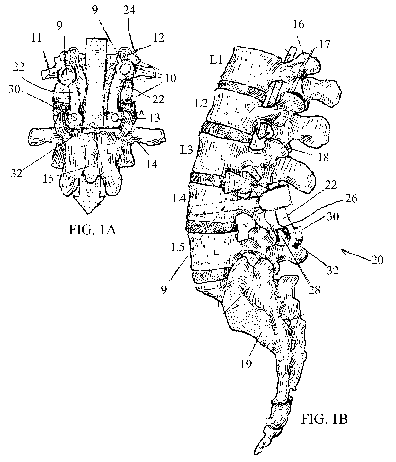 Posterior-medial facet support assembly