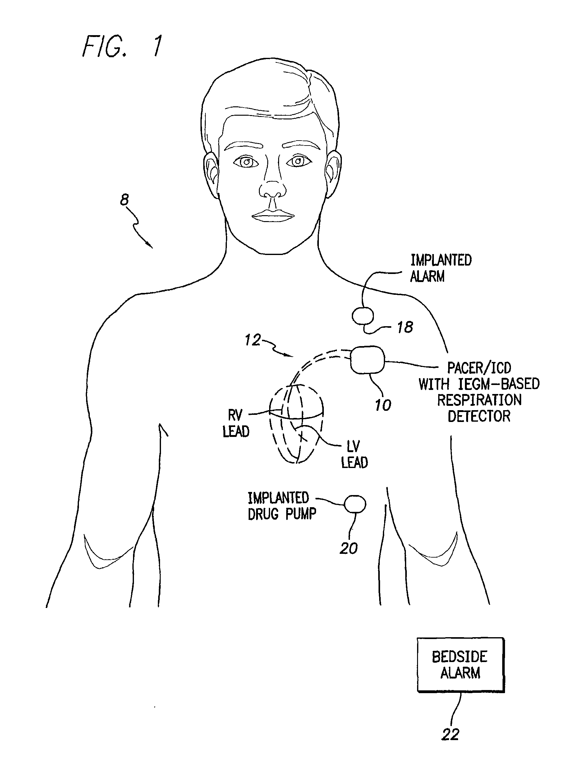 System and method for detecting physiologic states based on intracardiac electrogram signals while distinguishing cardiac rhythm types